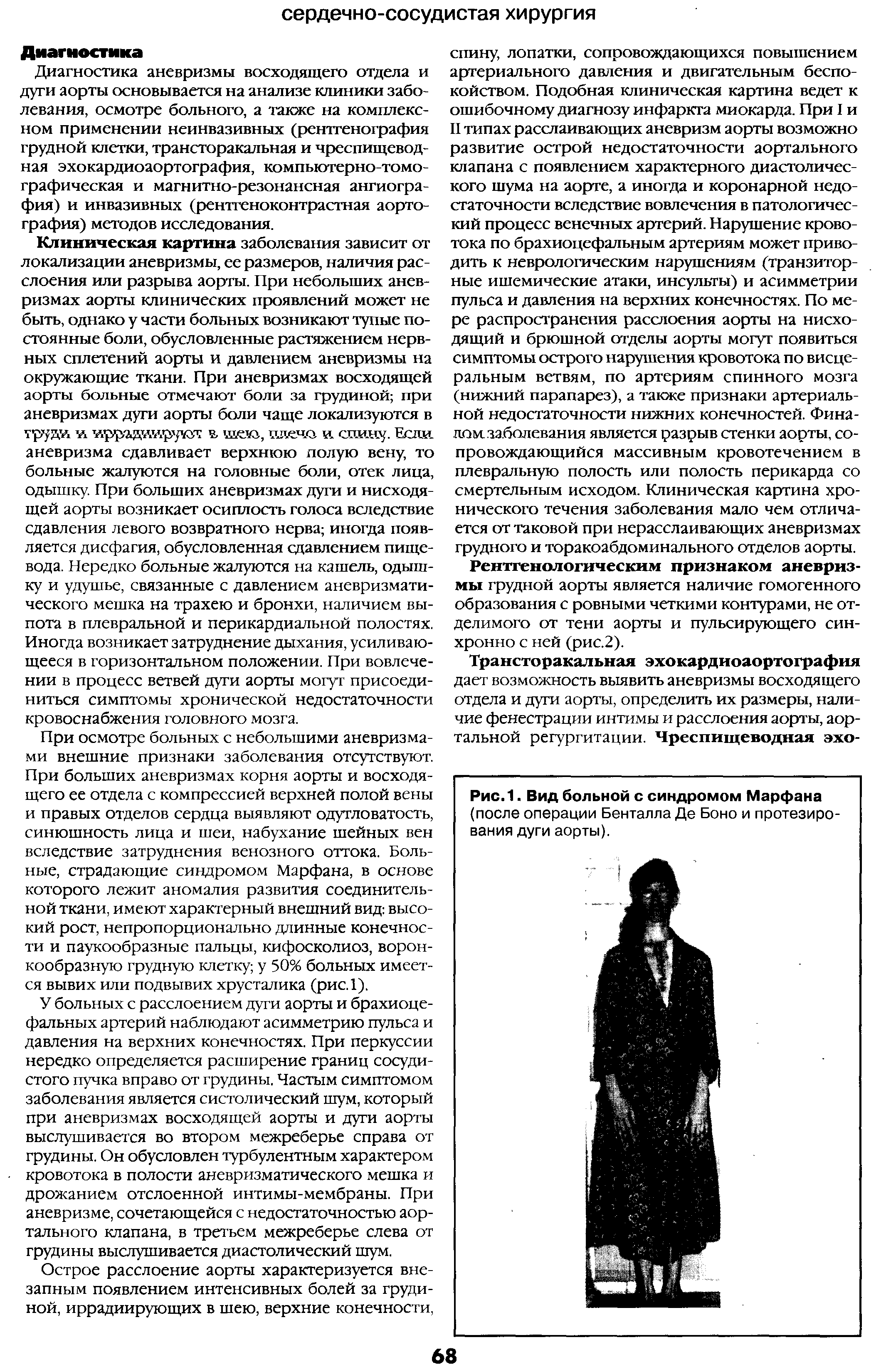 Рис. 1. Вид больной с синдромом Марфана (после операции Бенталла Де Боно и протезирования дуги аорты).