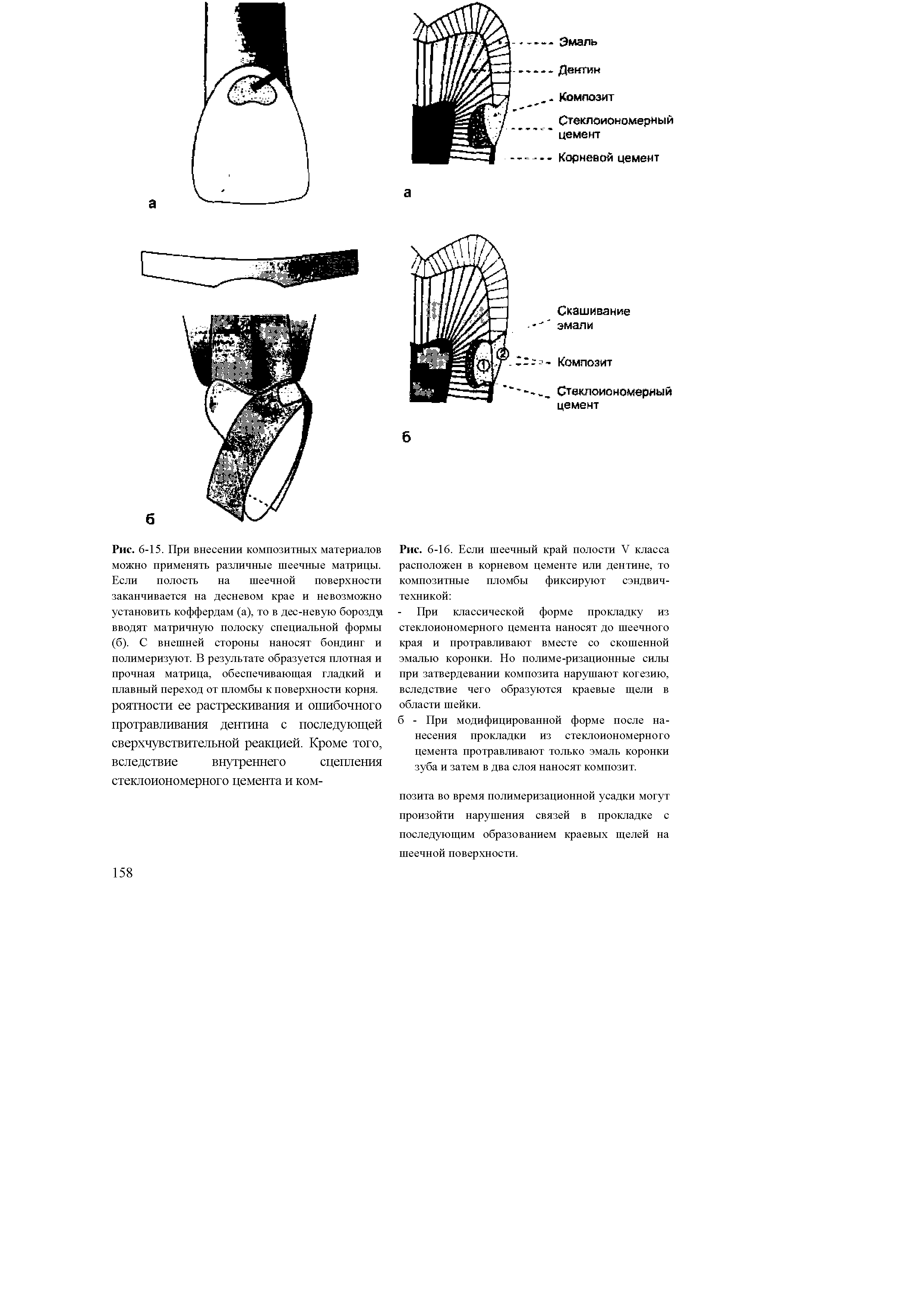 Рис. 6-16. Если шеечный край полости V класса расположен в корневом цементе или дентине, то композитные пломбы фиксируют сэндвич-техникой ...