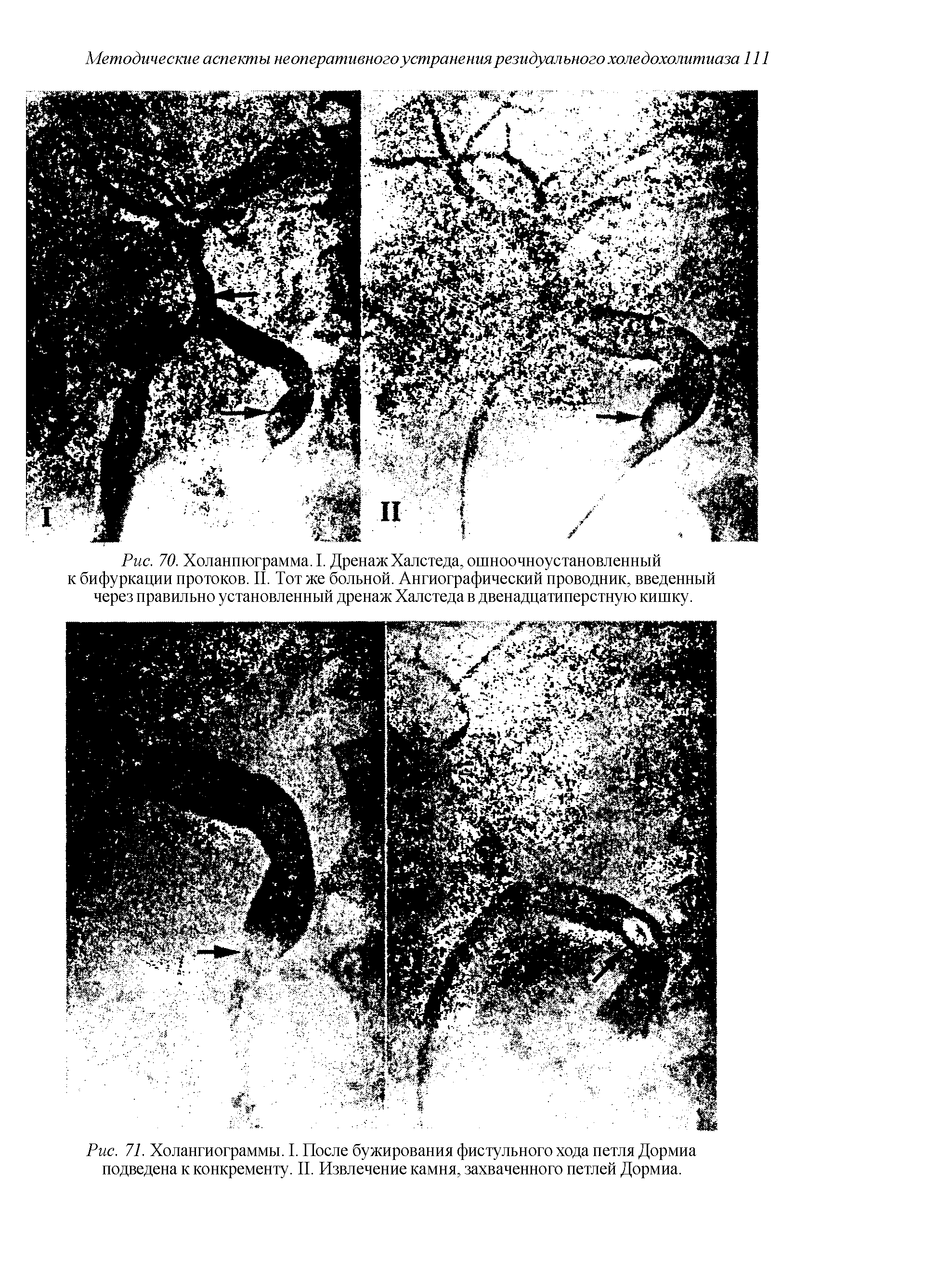 Рис. 71. Холангиограммы. I. После бужирования фистульного хода петля Дормиа подведена к конкременту. II. Извлечение камня, захваченного петлей Дормиа.
