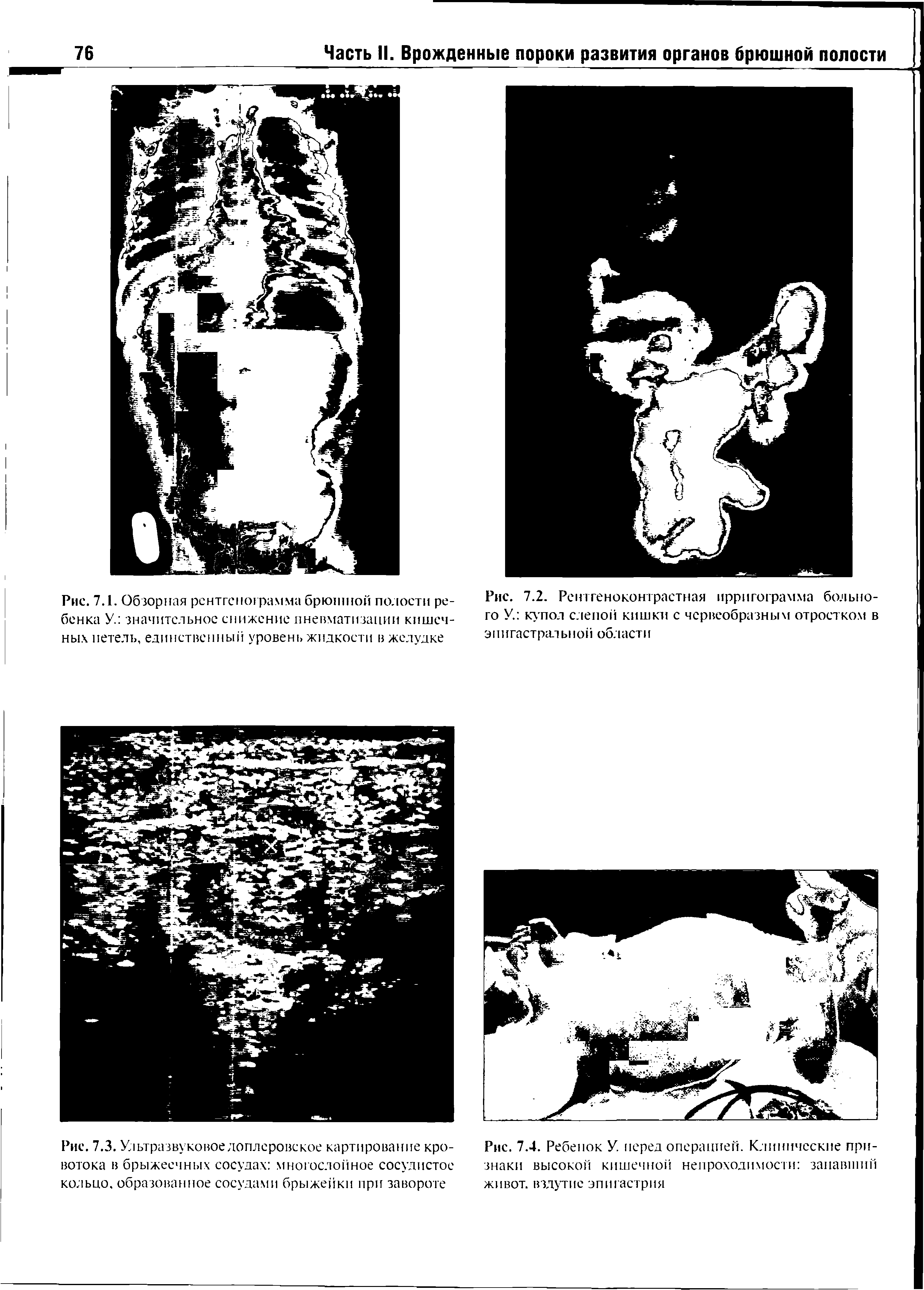 Рис. 7.3. Ультразвуковое доплеровское картирование кро-вотока в брыжеечных сосудах многослойное сосудистое кольцо, образованное сосудами брыжейки при завороте...