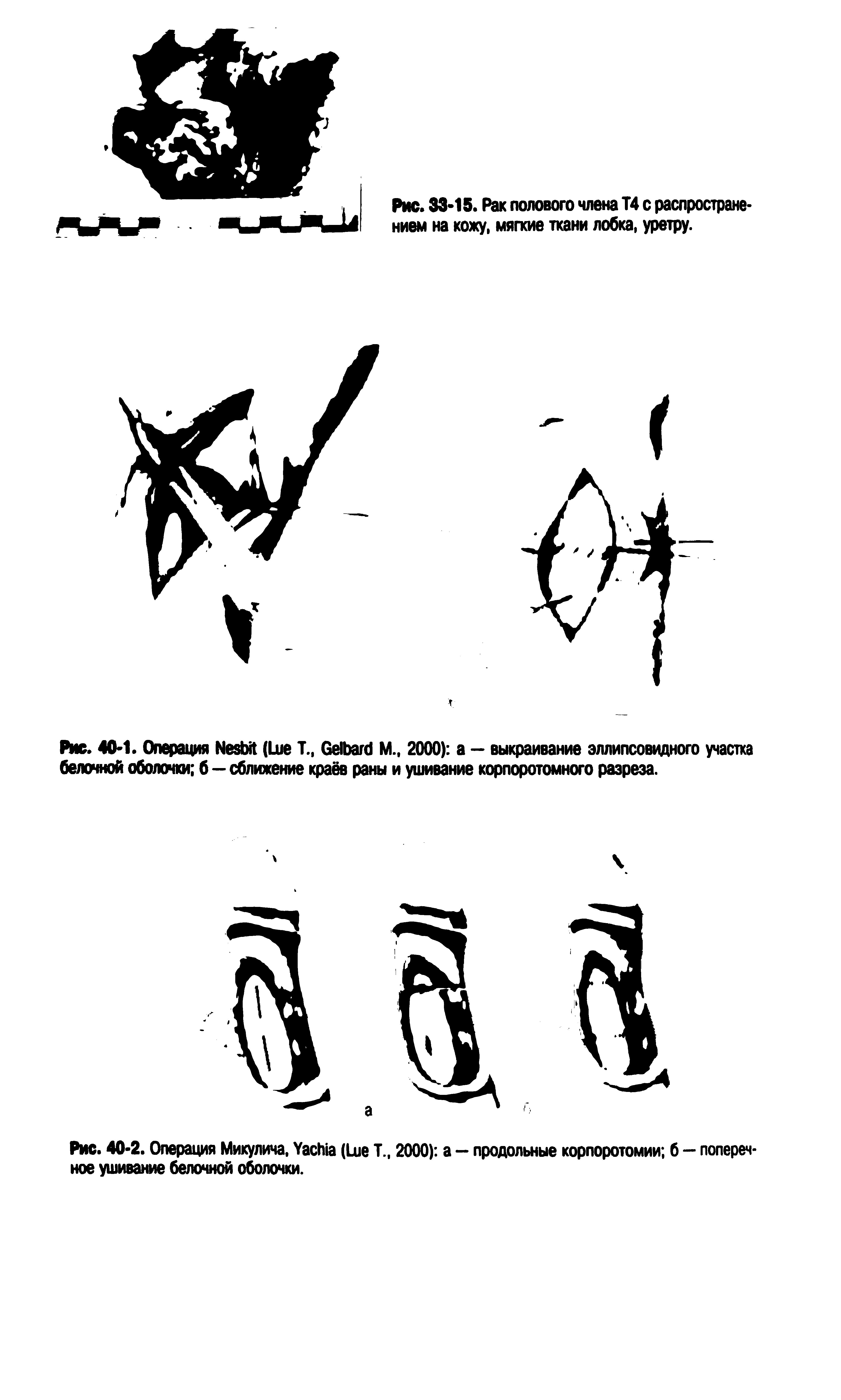 Рис. 40-2. Операция Микулича, Y (L T., 2000) а — продольные корпоротомии б — поперечное ушивание белочной оболочки.