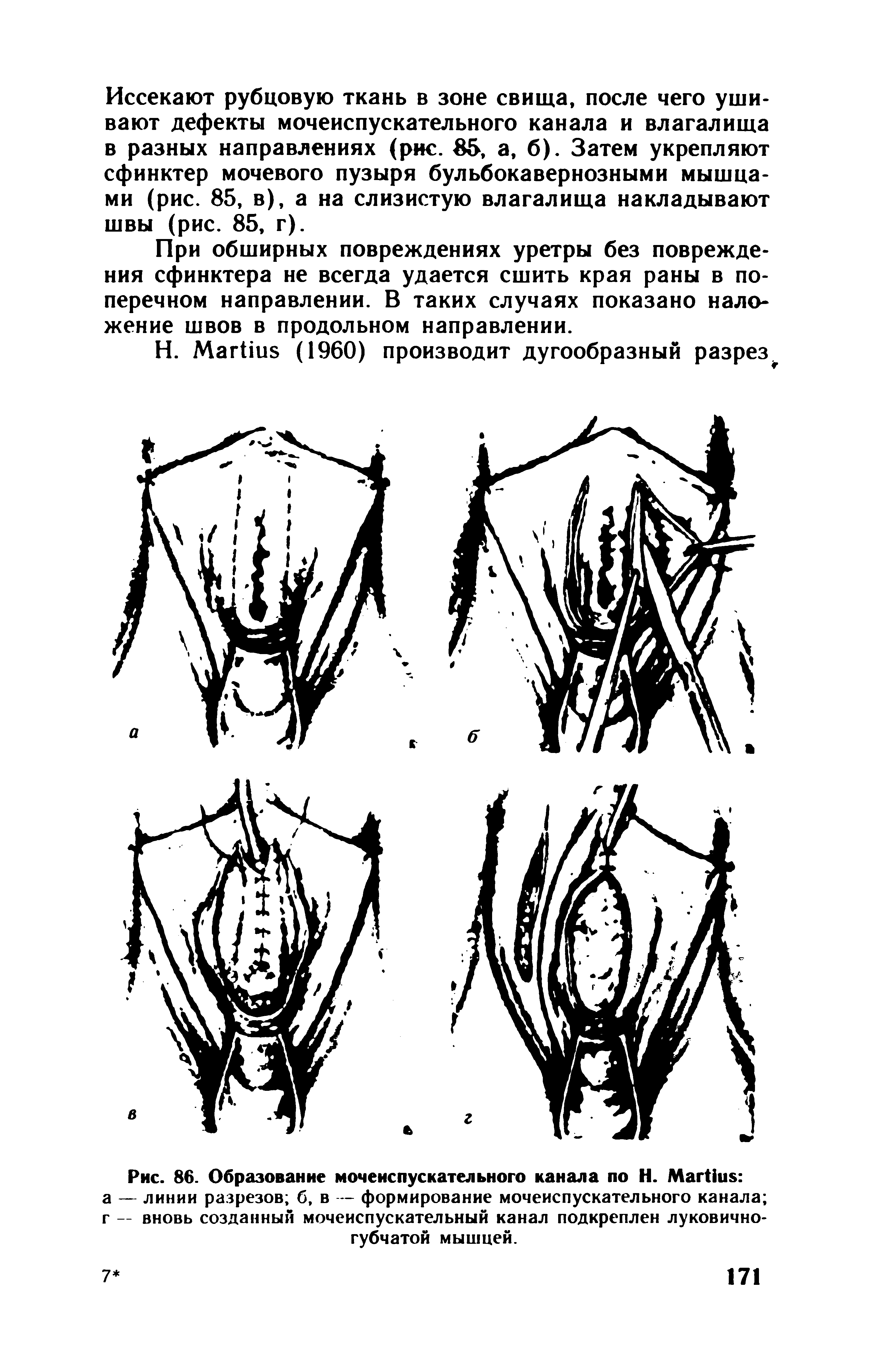 Рис. 86. Образование мочеиспускательного канала по Н. M а — линии разрезов б, в — формирование мочеиспускательного канала г — вновь созданный мочеиспускательный канал подкреплен луковичногубчатой мышцей.