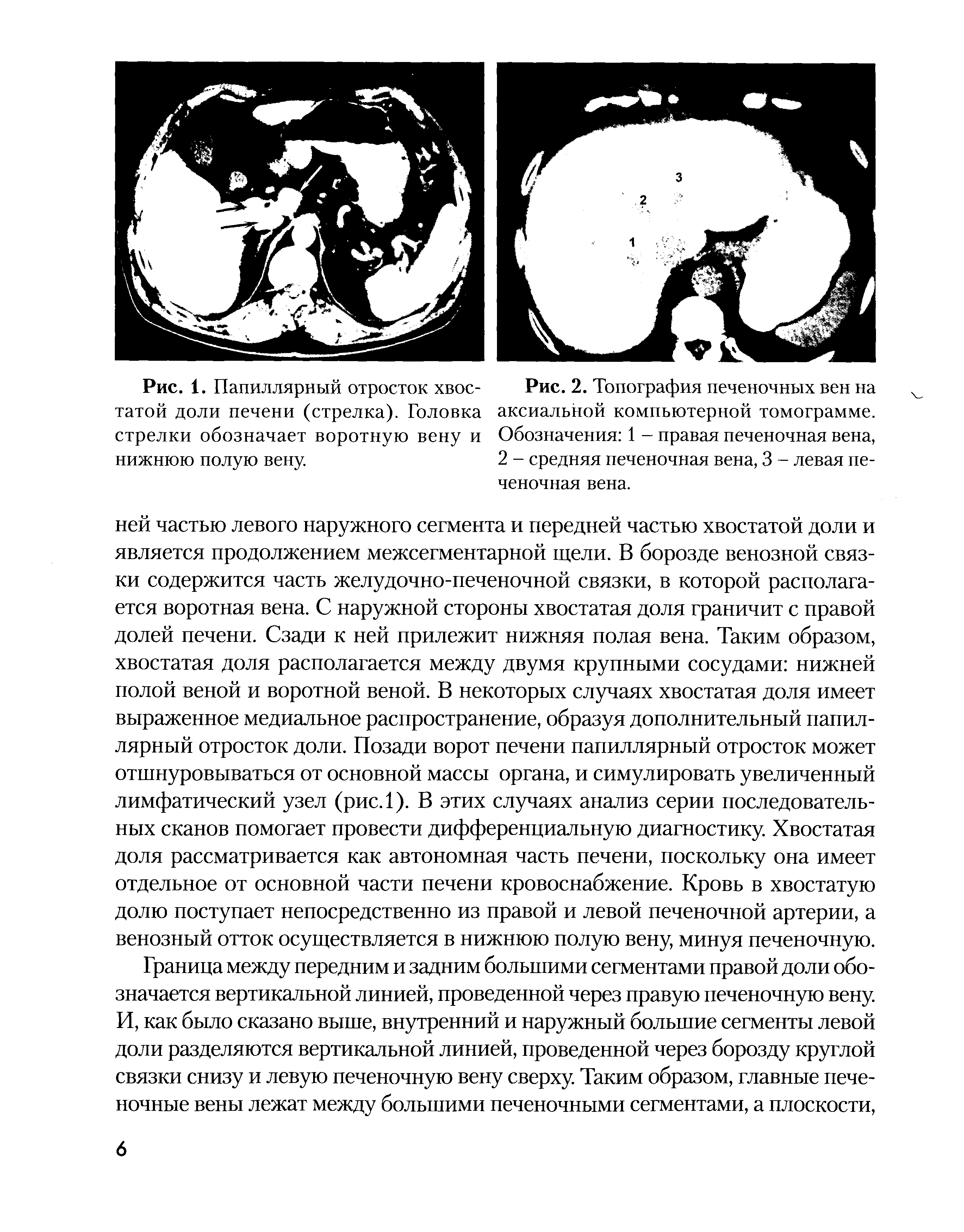 Рис. 1. Папиллярный отросток хвостатой доли печени (стрелка). Головка стрелки обозначает воротную вену и нижнюю полую вену...