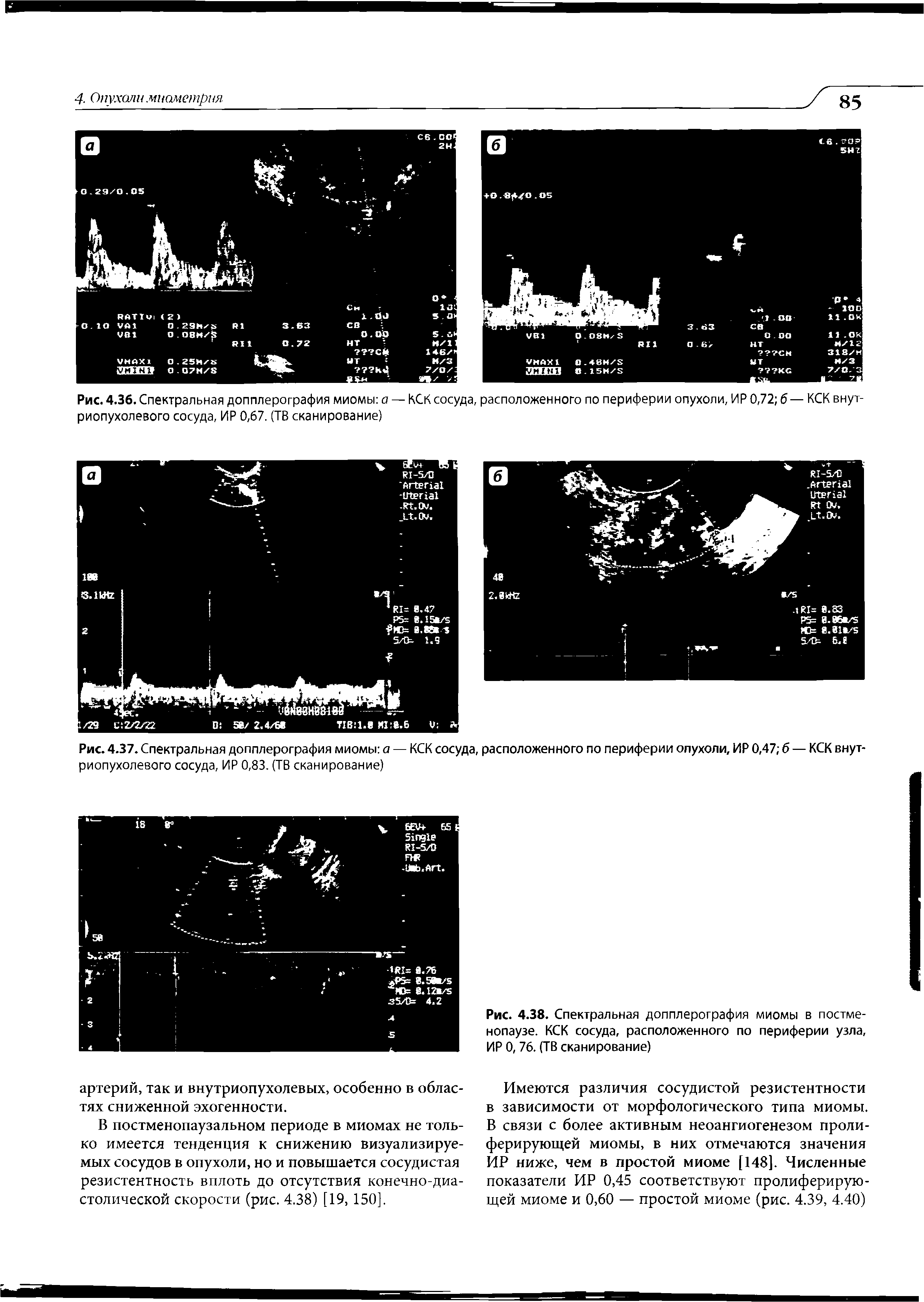 Рис. 4.36. Спектральная допплерография миомы а — КСК сосуда, расположенного по периферии опухоли, ИР 0,72 б — КСК внут-риопухолевого сосуда, ИР 0,67. (ТВ сканирование)...