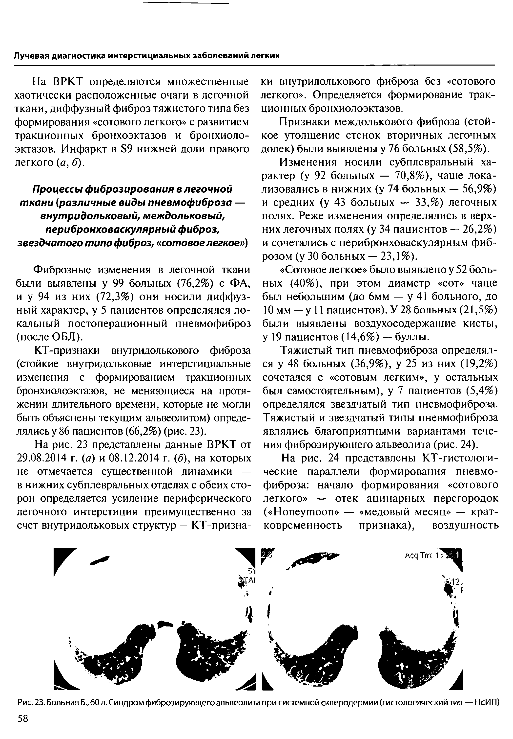 Рис. 23. Больная Б., 60 л. Синдром фиброзирующего альвеолита при системной склеродермии (гистологический тип — НсИП)...