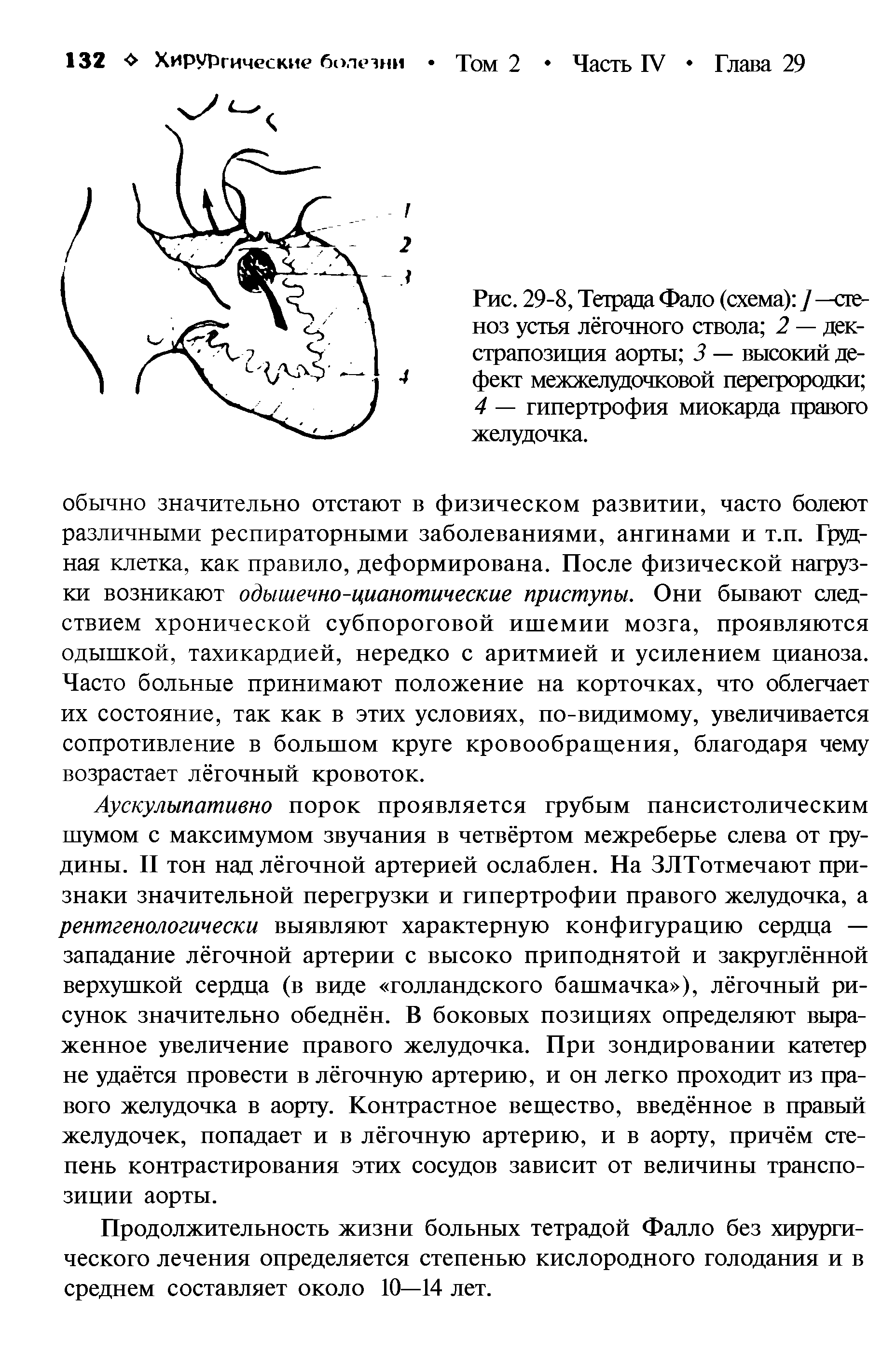 Рис. 29-8, Тетрада Фало (схема) /—стеноз устья лёгочного ствола 2 — дек-страпозиция аорты 3 — высокий дефект межжелудочковой перегрородки 4 — гипертрофия миокарда правого желудочка.