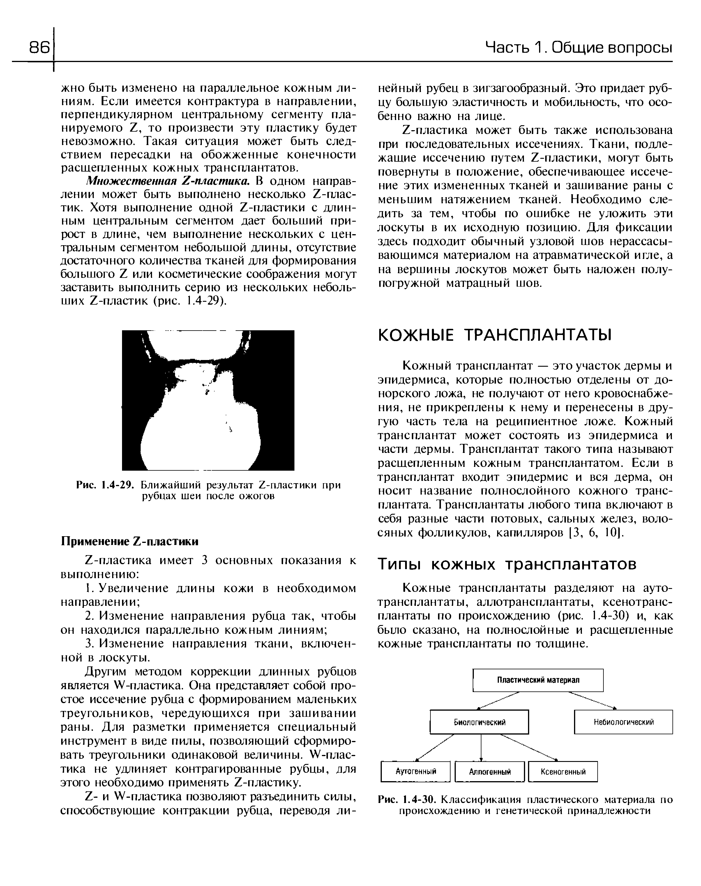 Рис. 1.4-29. Ближайший результат /-пластики при рубцах шеи после ожогов...