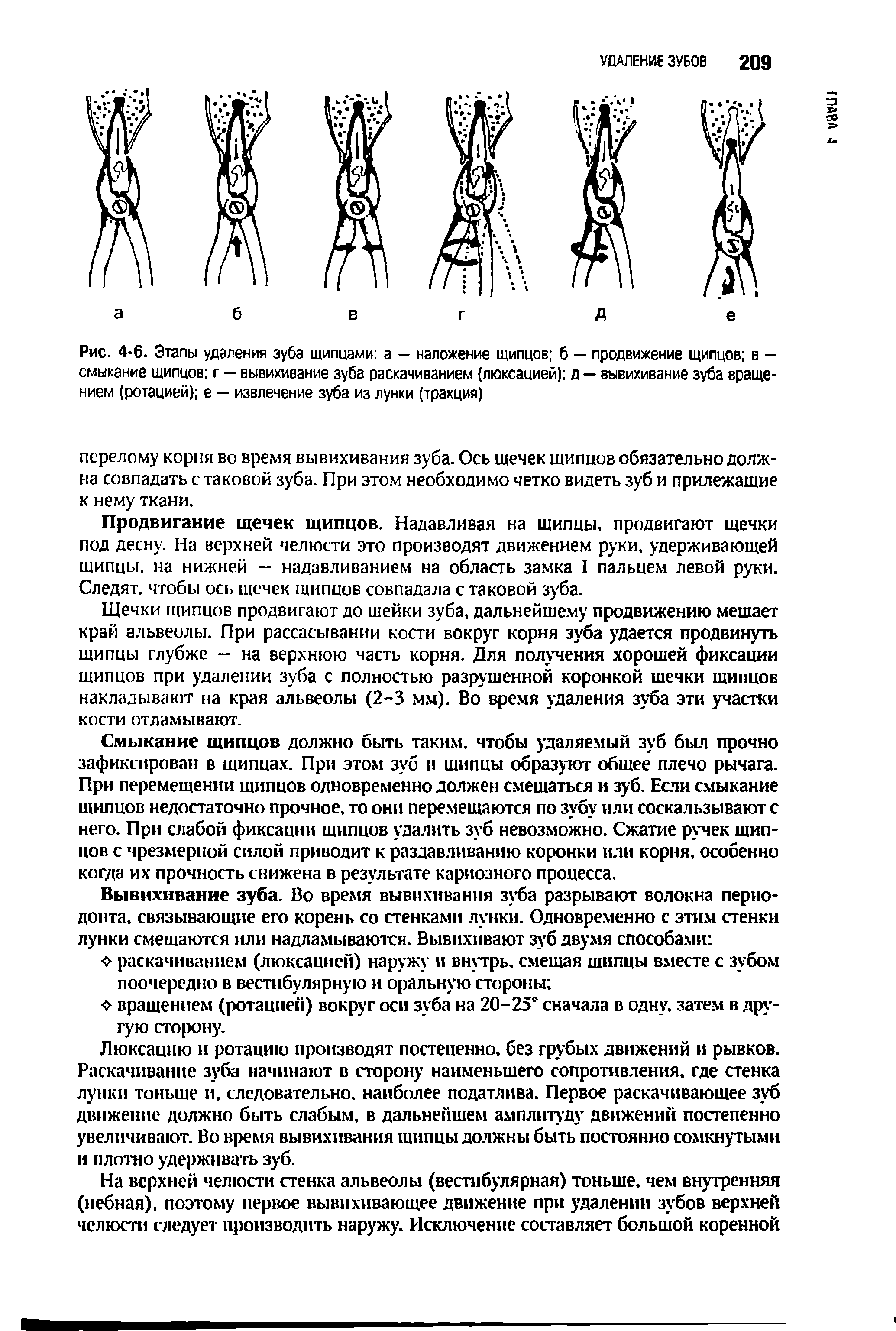 Рис. 4-6. Этапы удаления зуба щипцами а — наложение щипцов б — продвижение щипцов в — смыкание щипцов г — вывихивание зуба раскачиванием (люксацией) д — вывихивание зуба вращением (ротацией) е — извлечение зуба из лунки (тракция).