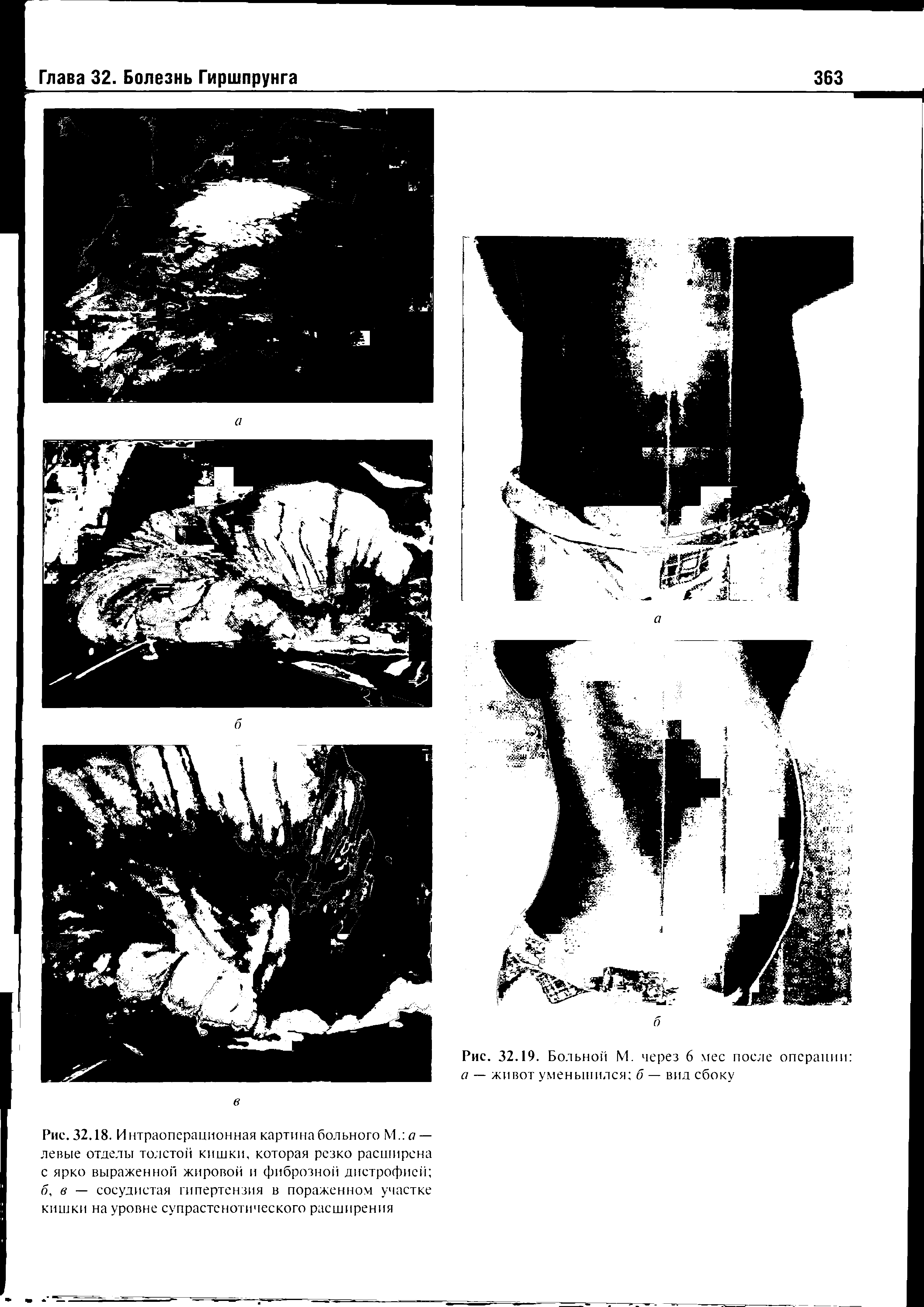 Рис. 32.18. Интраоперационная картина больного М. д — левые отделы толстой кишки, которая резко расширена с ярко выраженной жировой и фиброзной дистрофией б, в — сосудистая гипертензия в пораженном участке кишки на уровне супрастснотического расширения...