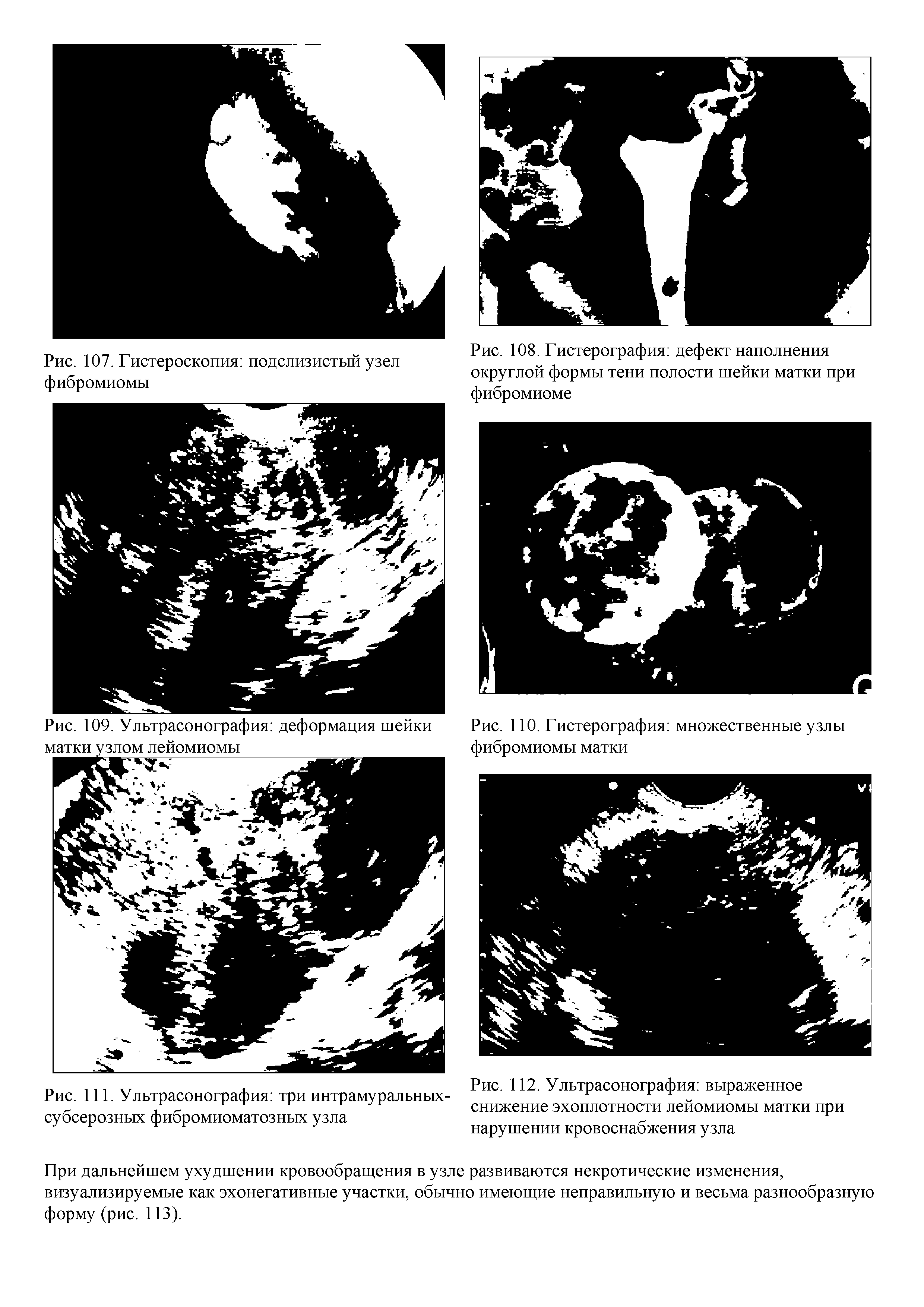 Рис. 109. Ультрасонография деформация шейки матки узлом лейомиомы...