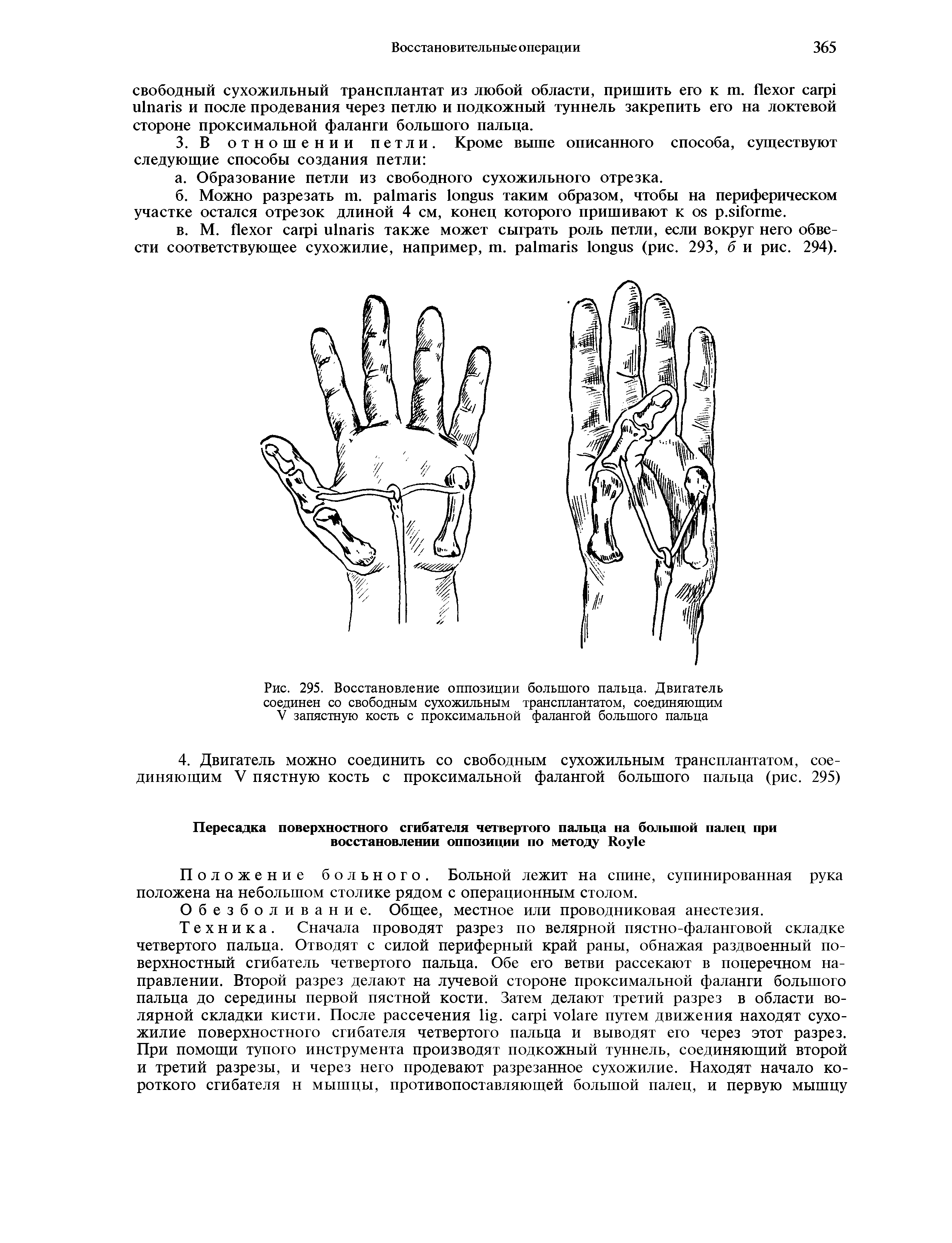 Рис. 295. Восстановление оппозиции большого пальца. Двигатель соединен со свободным сухожильным трансплантатом, соединяющим V запястную кость с проксимальной фалангой большого пальца...
