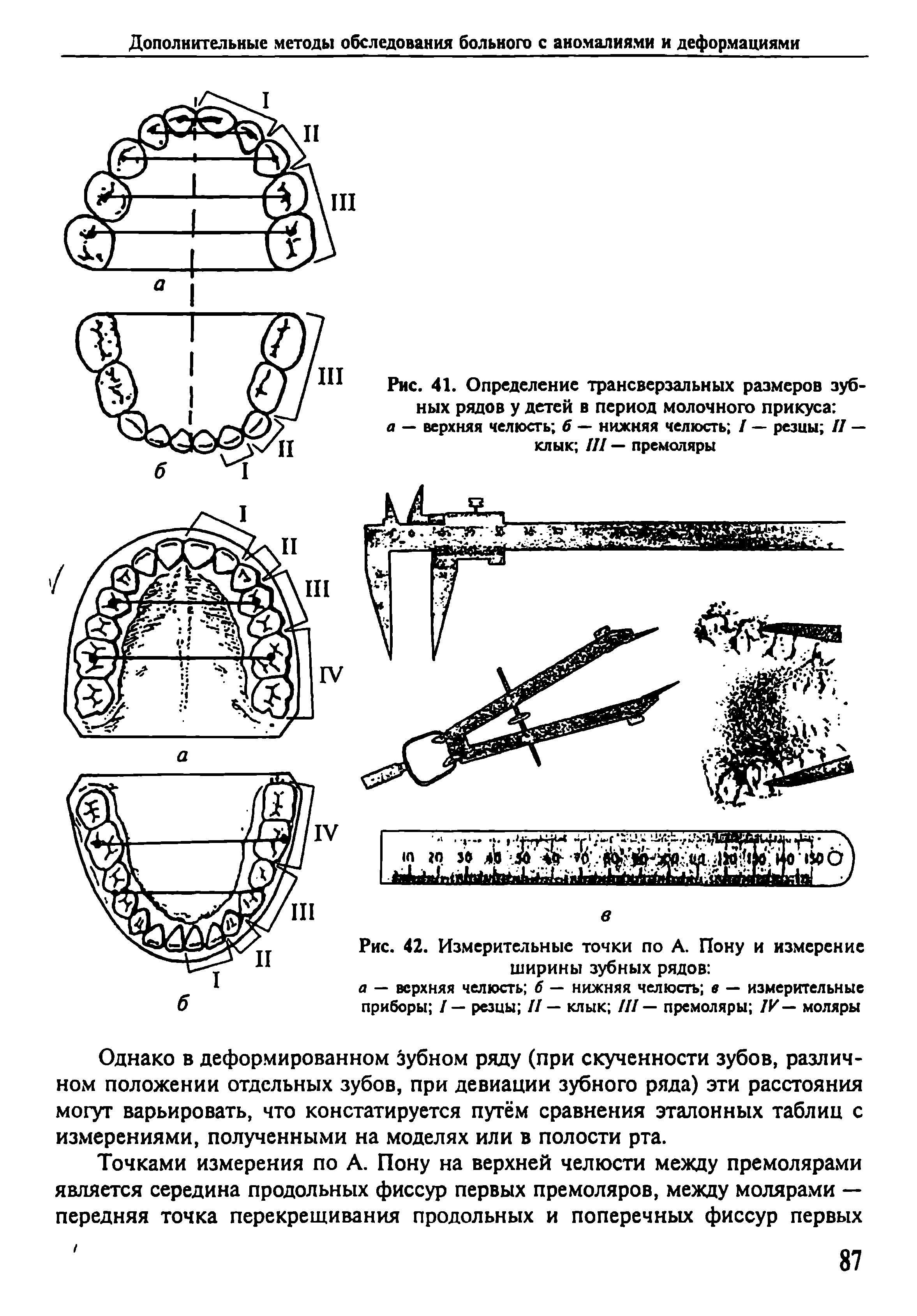 Рис. 42. Измерительные точки по А. Пону и измерение ширины зубных рядов ...