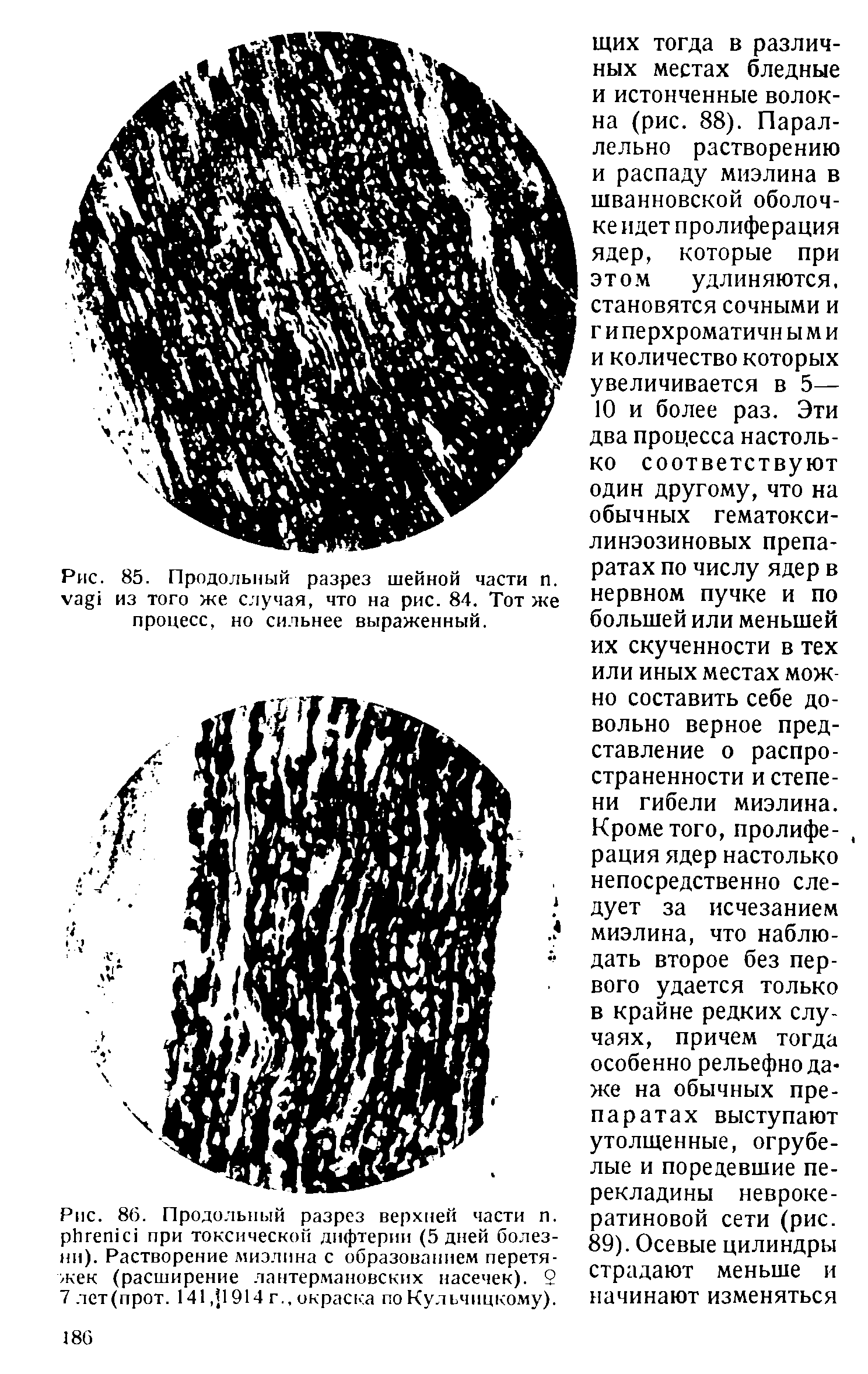 Рис. 86. Продольный разрез верхней части п. р11гетс1 при токсической дифтерии (5 дней болезни). Растворение миэлина с образованием перетяжек (расширение лантермановских насечек). 2 7 лет(прот. 141,11914 г., окраска по Кульчицкому).