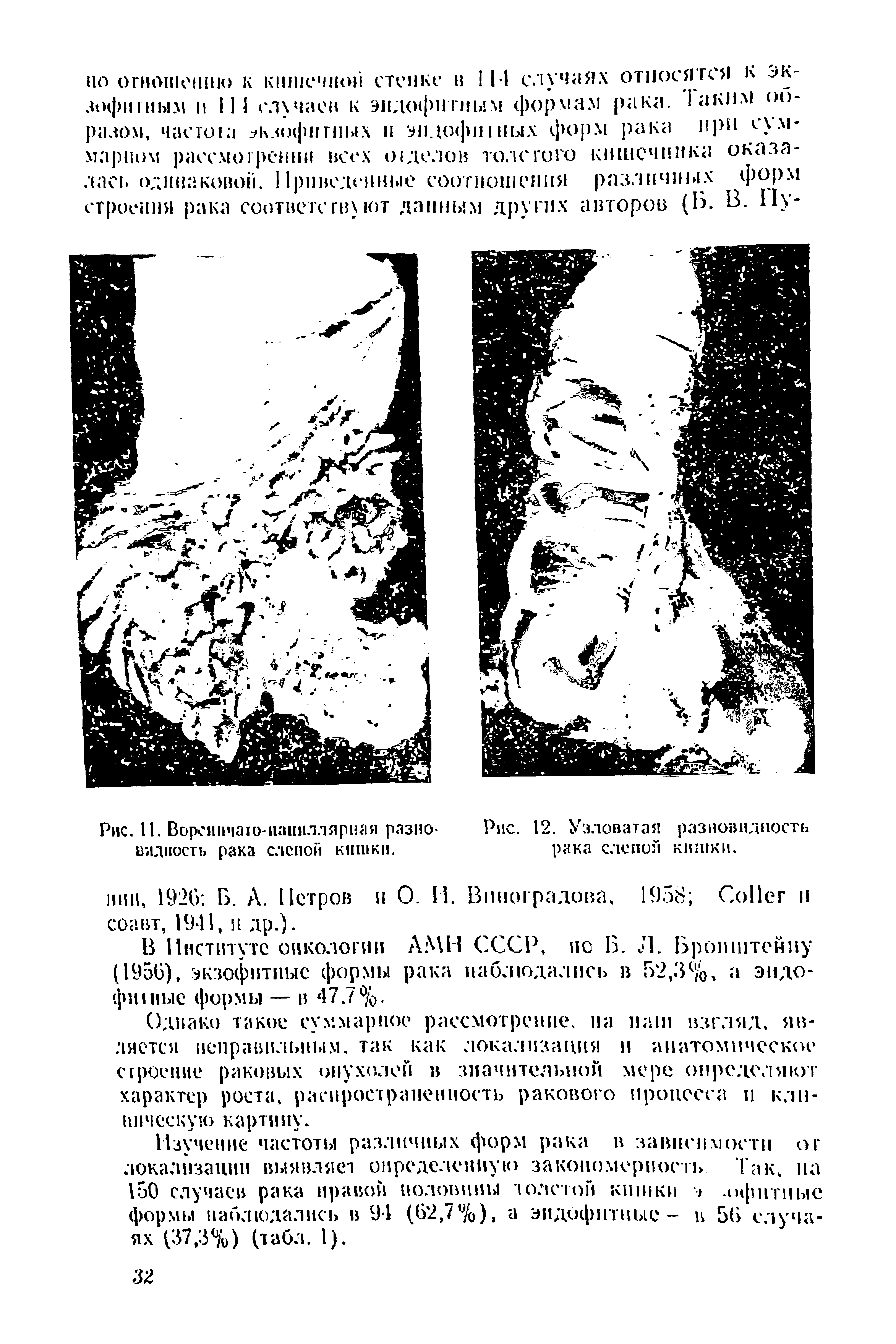 Рис. II. Ворсинчато-папиллярная разновидность рака слепой кишки.