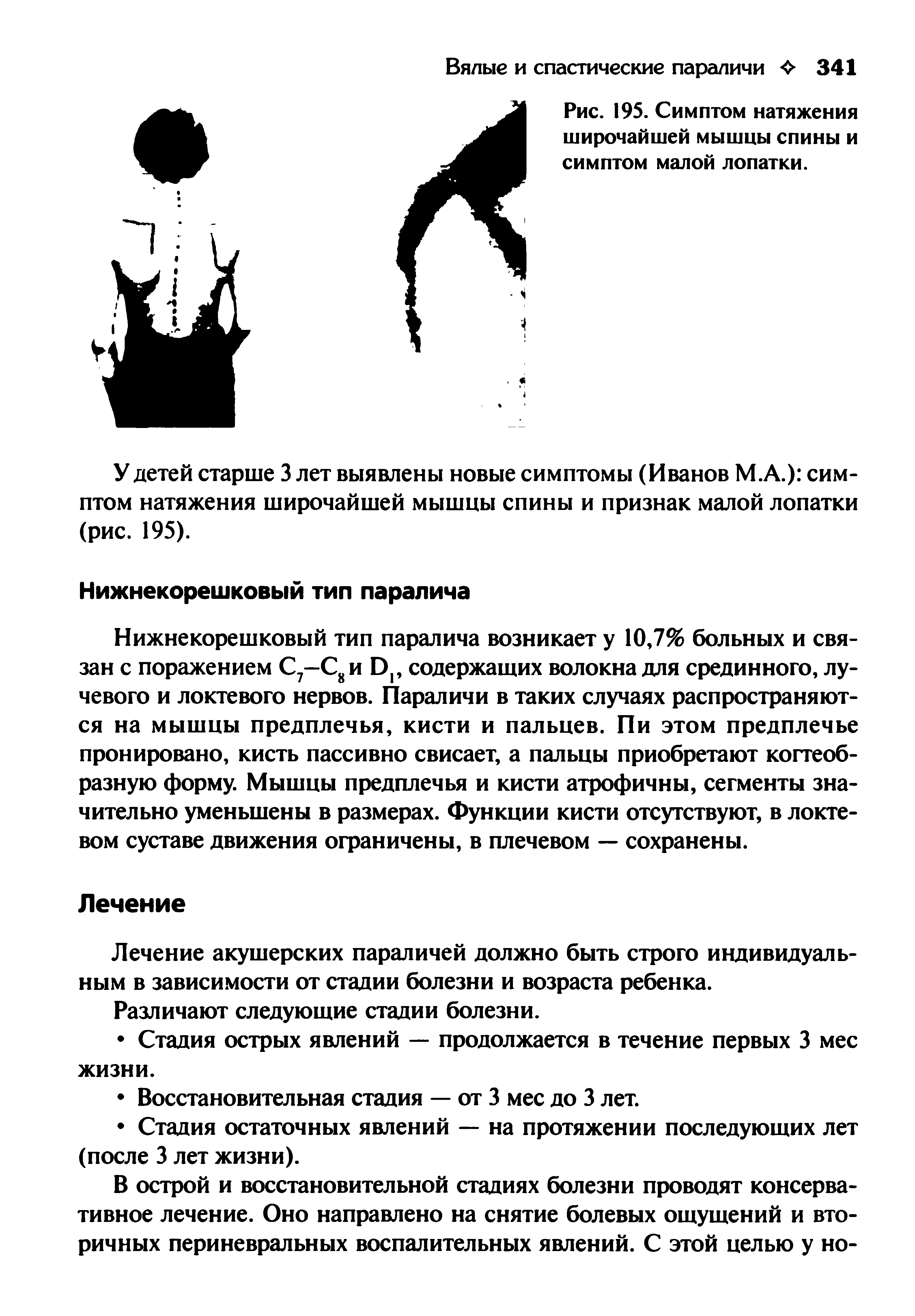 Рис. 195. Симптом натяжения широчайшей мышцы спины и симптом малой лопатки.