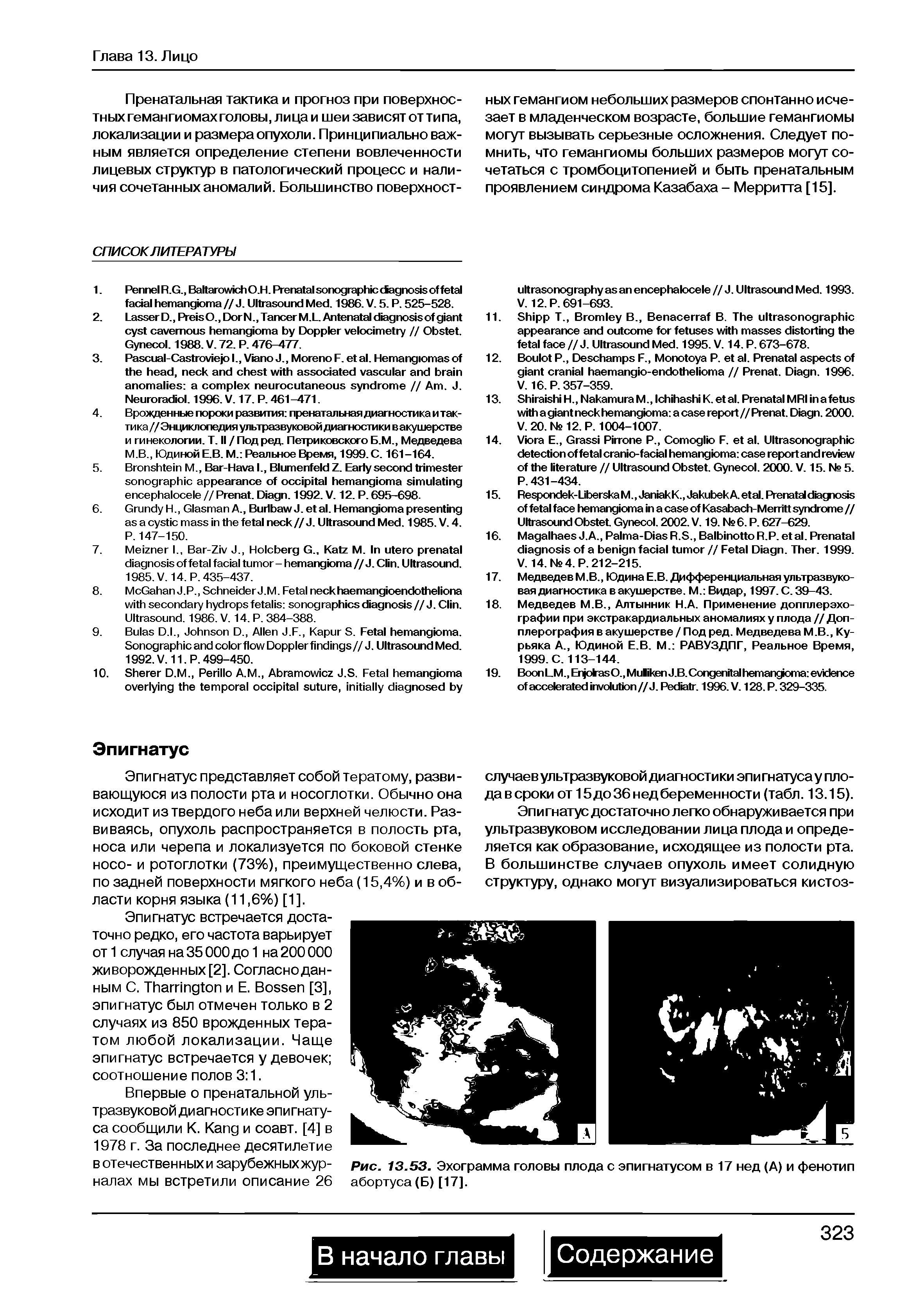 Рис. 13.53. Эхограмма головы плода с эпигнатусом в 17 нед (А) и фенотип абортуса (Б) [17].