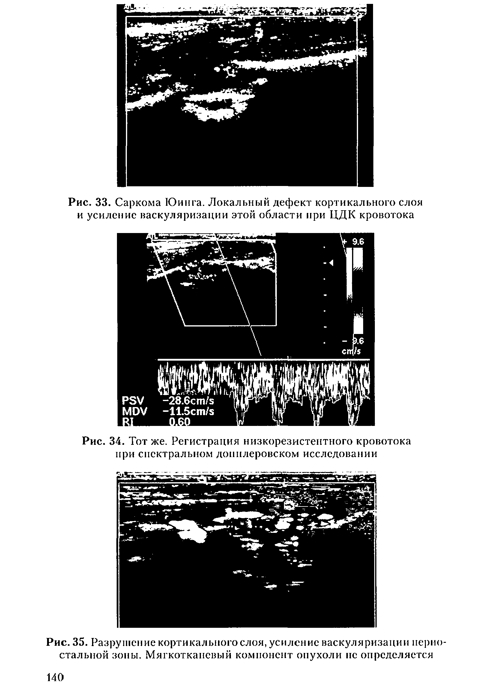 Рис. 34. Тот же. Регистрация низкорезистентного кровотока при спектральном допплеровском исследовании...