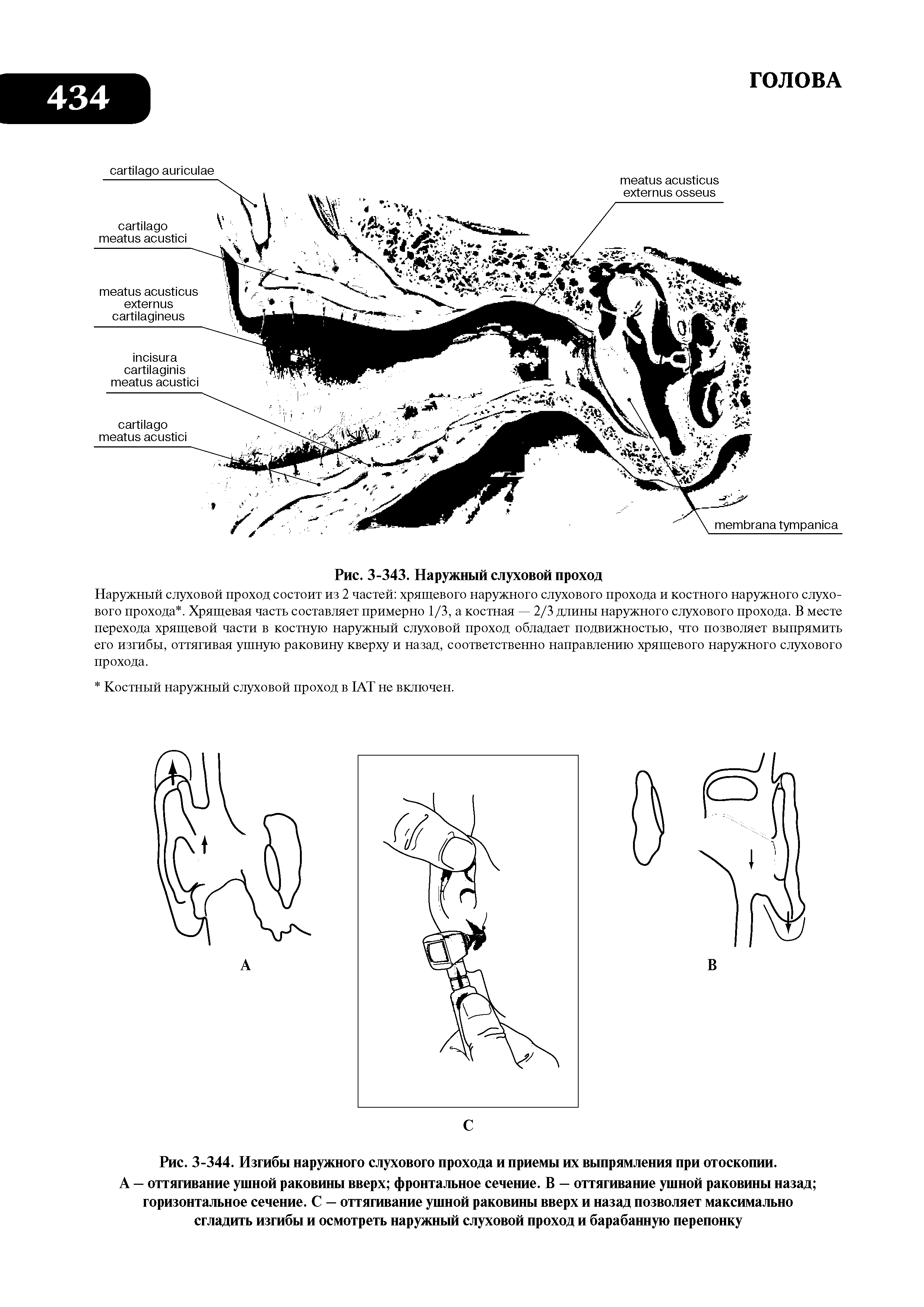 Рис. 3-344. Изгибы наружного слухового прохода и приемы их выпрямления при отоскопии. А — оттягивание ушной раковины вверх фронтальное сечение. В — оттягивание ушной раковины назад горизонтальное сечение. С — оттягивание ушной раковины вверх и назад позволяет максимально сгладить изгибы и осмотреть наружный слуховой проход и барабанную перепонку...