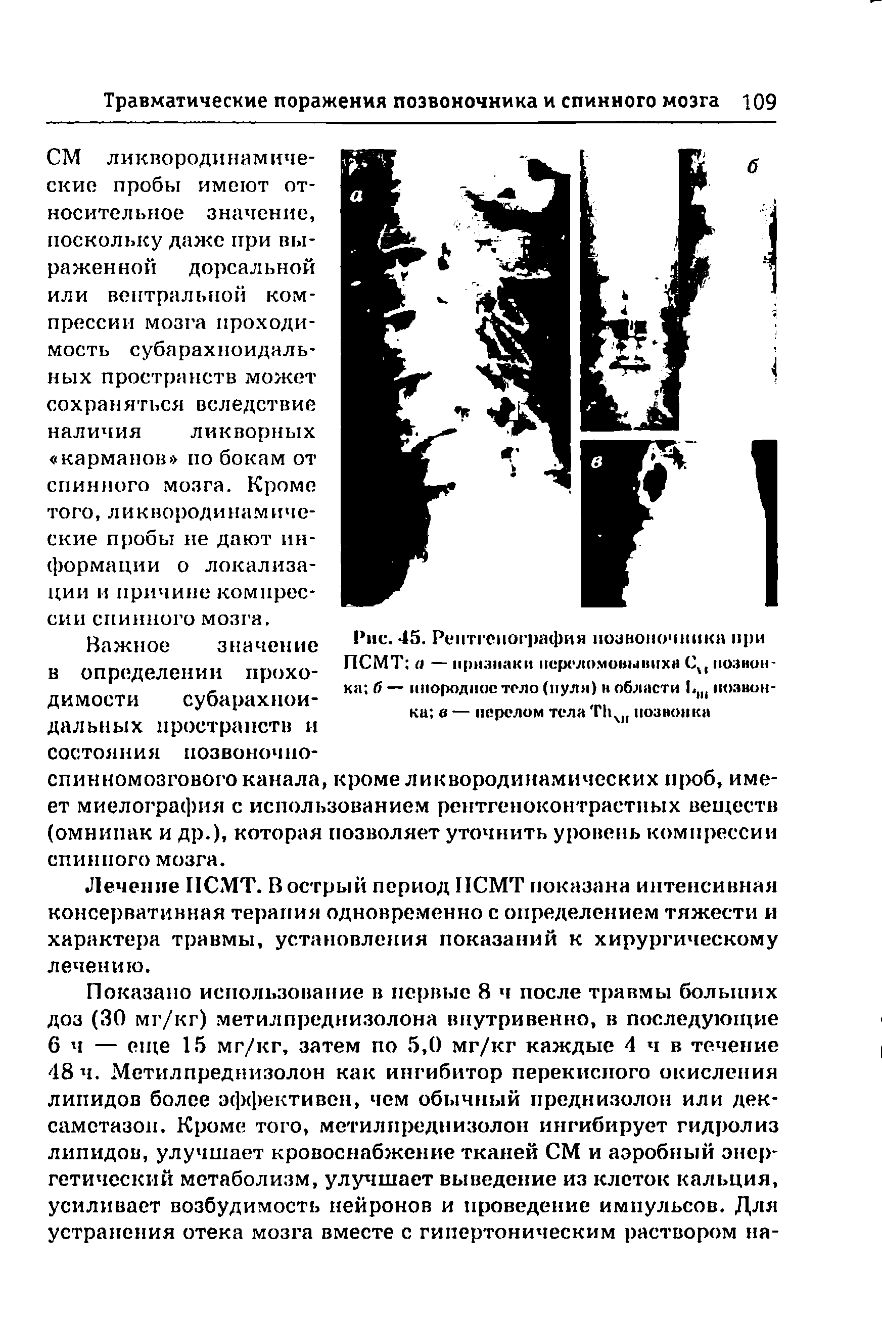 Рис. 45. Рентгенография позвоночника при ПСМТ а — признаки переломовывиха Си позвонка б — инородное тело (пуля) в области Ц ( позвонка в — перелом тела Т1 ч позвонка...