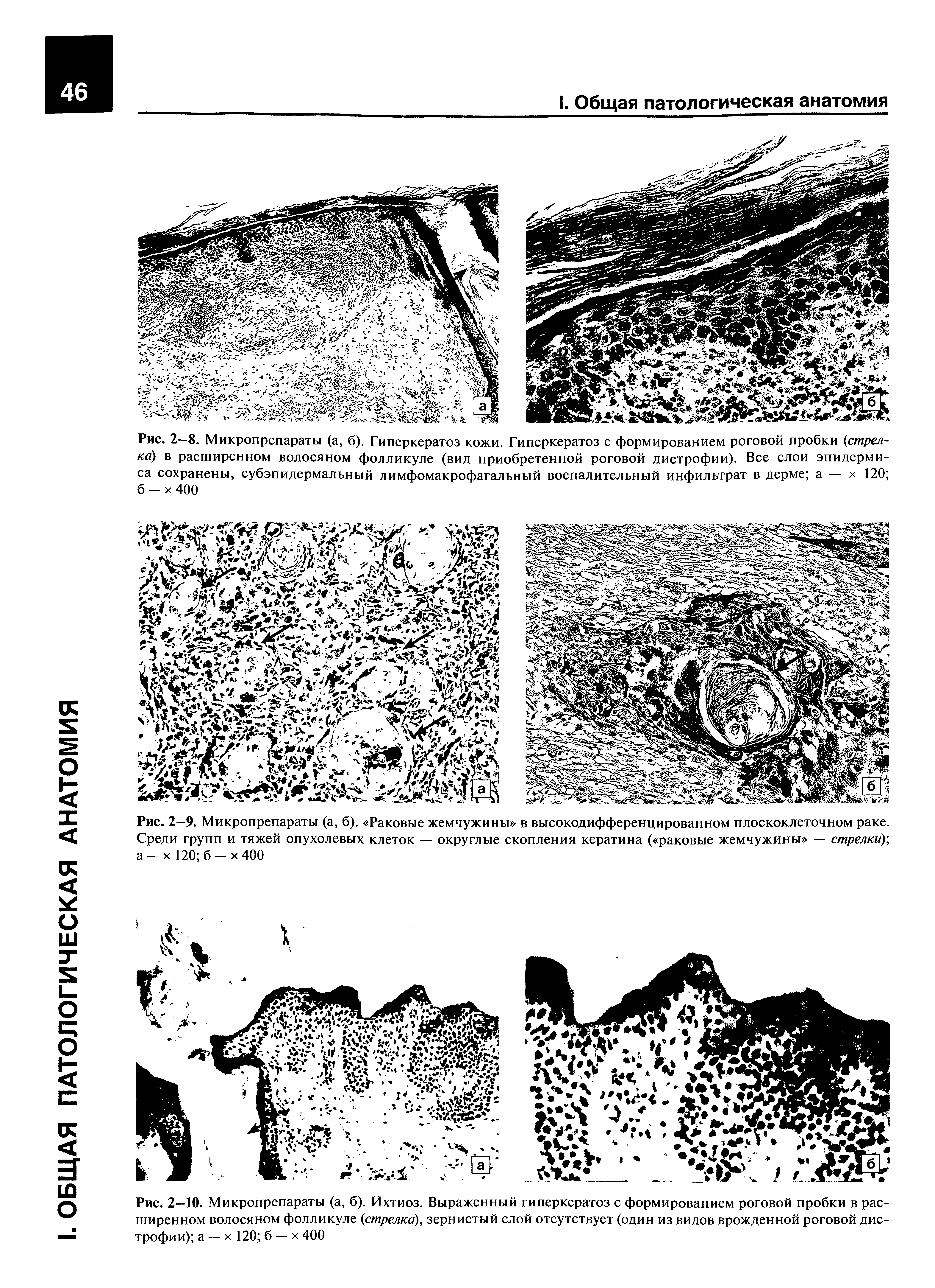 Рис. 2—9. Микропрепараты (а, б). Раковые жемчужины в высокодифференцированном плоскоклеточном раке. Среди групп и тяжей опухолевых клеток — округлые скопления кератина ( раковые жемчужины — стрелки), а — х 120 б — х 400...