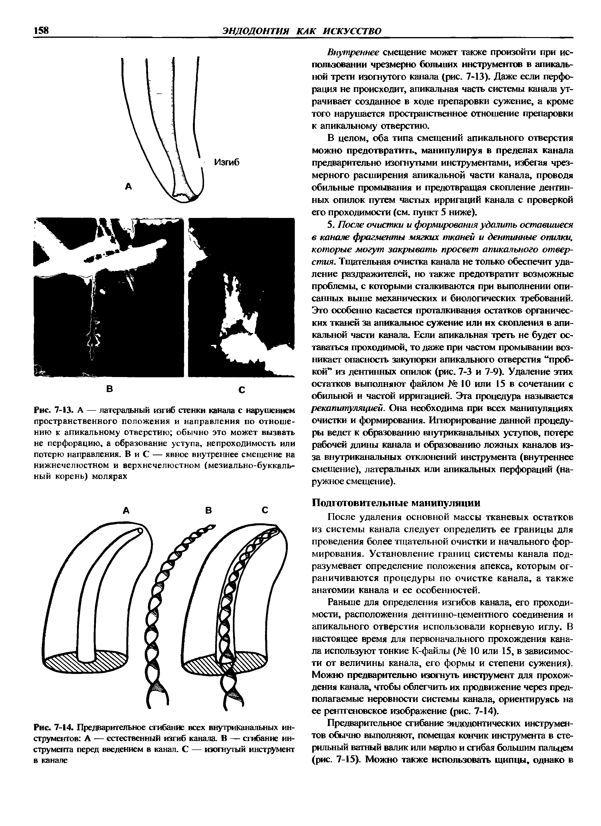 Рис. 7-13. А — латеральный изгиб стенки канала с нарушением пространственного положения и направления по отношению к апикальному отверстию обычно это может вызвать не перфорацию, а образование уступа, непроходимость или потерю направления. В и С — явное внутреннее смещение на нижнечелюстном и верхнечелюстном (мезиально-буккальный корень) молярах...