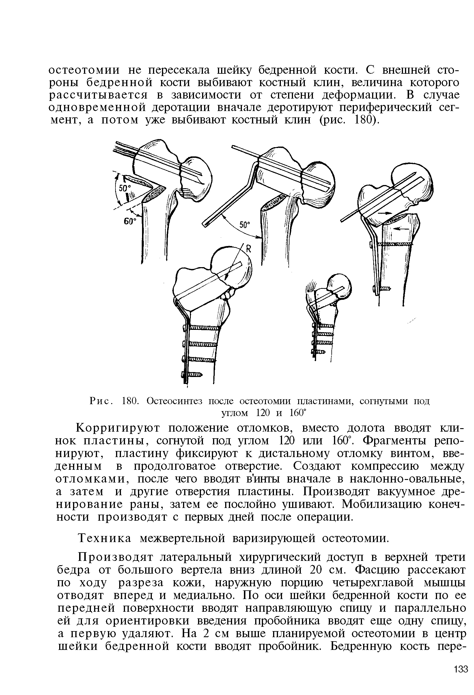 Рис. 180. Остеосинтез после остеотомии пластинами, согнутыми под углом 120 и 160°...