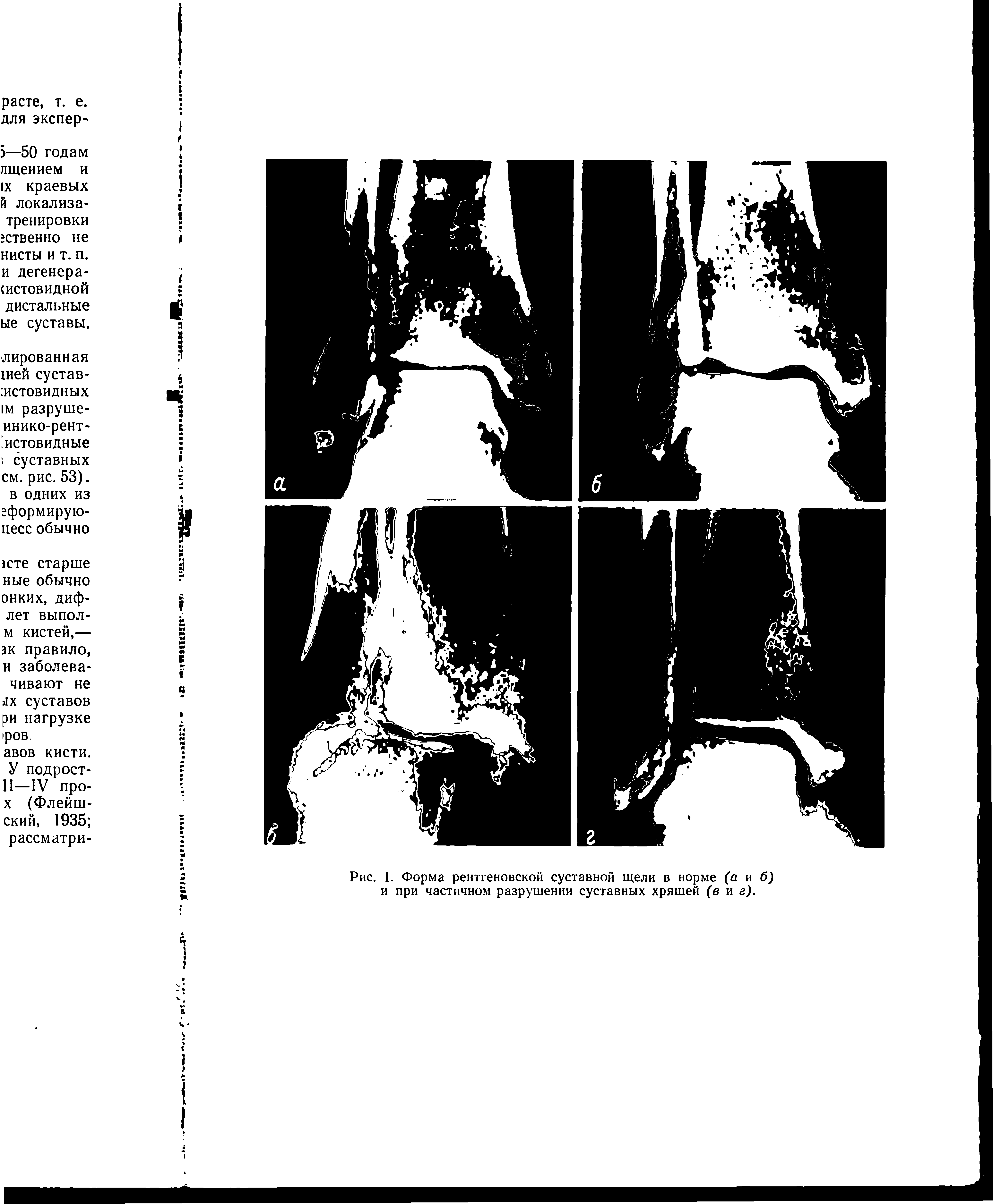 Рис. 1. Форма рентгеновской суставной щели в норме (а и б) и при частичном разрушении суставных хряшей (в и г).