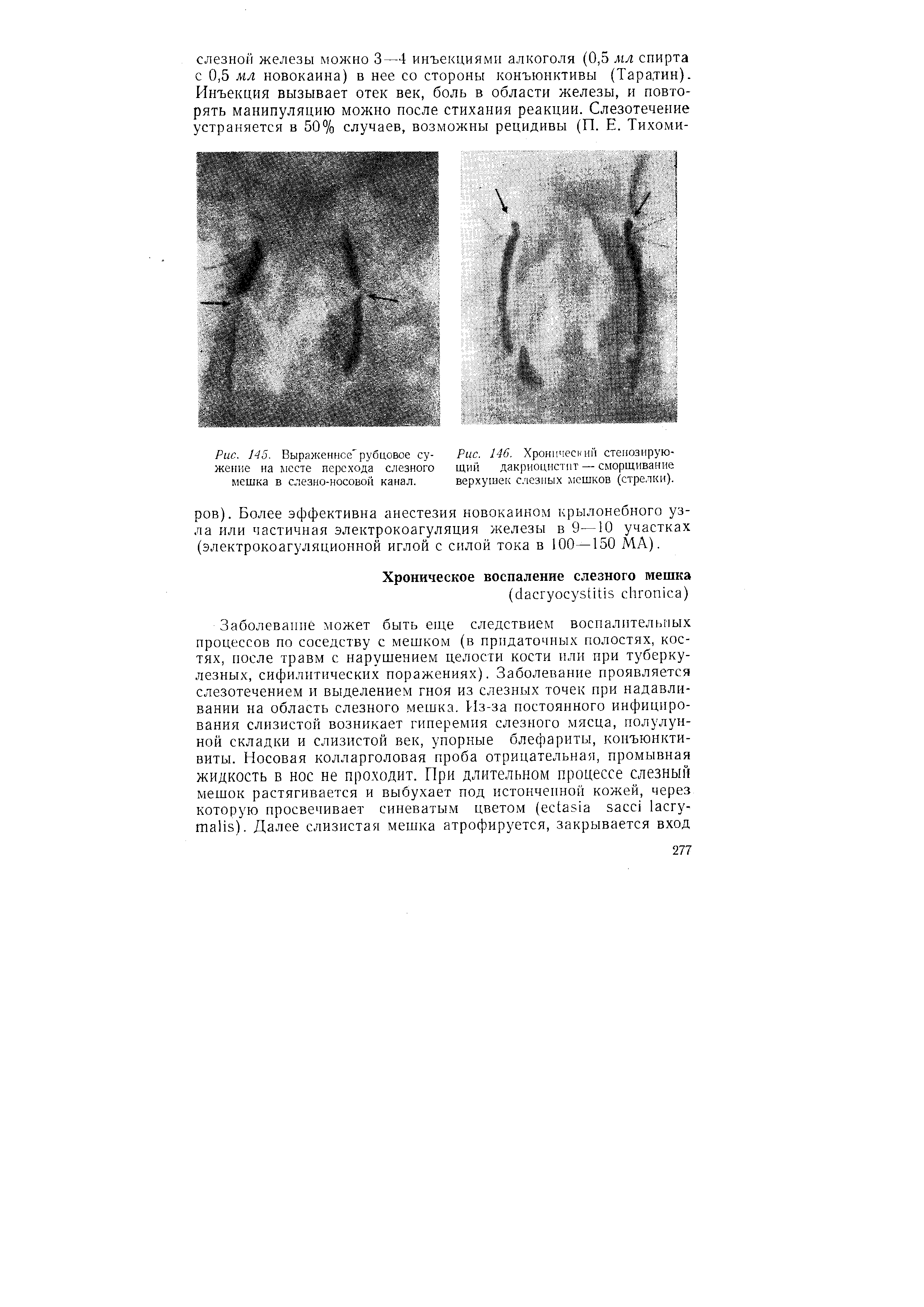 Рис. 146. Хронический стенозирующий дакриоцистит — сморщивание верхушек слезных мешков (стрелки).