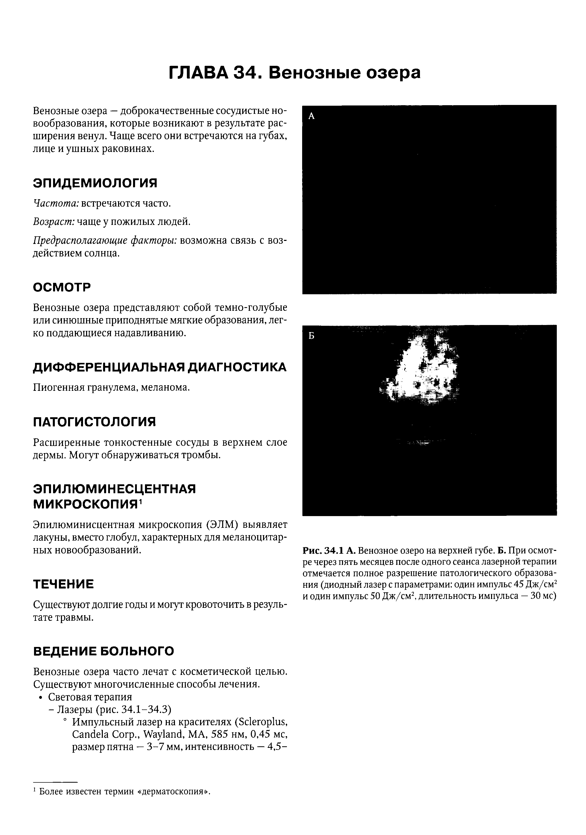 Рис. 34.1 А. Венозное озеро на верхней губе. Б. При осмотре через пять месяцев после одного сеанса лазерной терапии отмечается полное разрешение патологического образования (диодный лазер с параметрами один импульс 45 Дж/см2 и один импульс 50 Дж/см2, длительность импульса — 30 мс)...