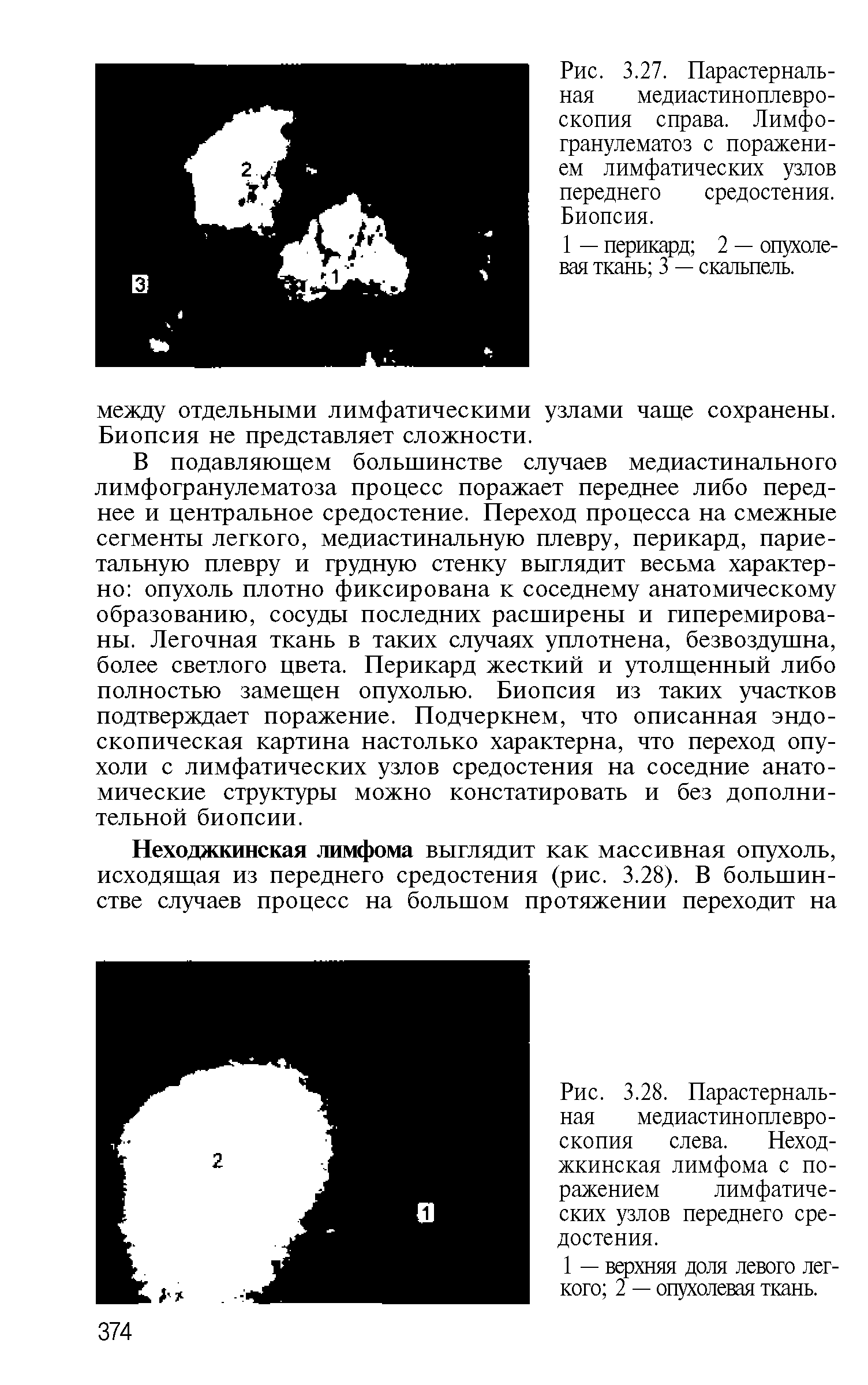 Рис. 3.28. Парастернальная медиастиноплевро-скопия слева. Неходжкинская лимфома с поражением лимфатических узлов переднего средостения.