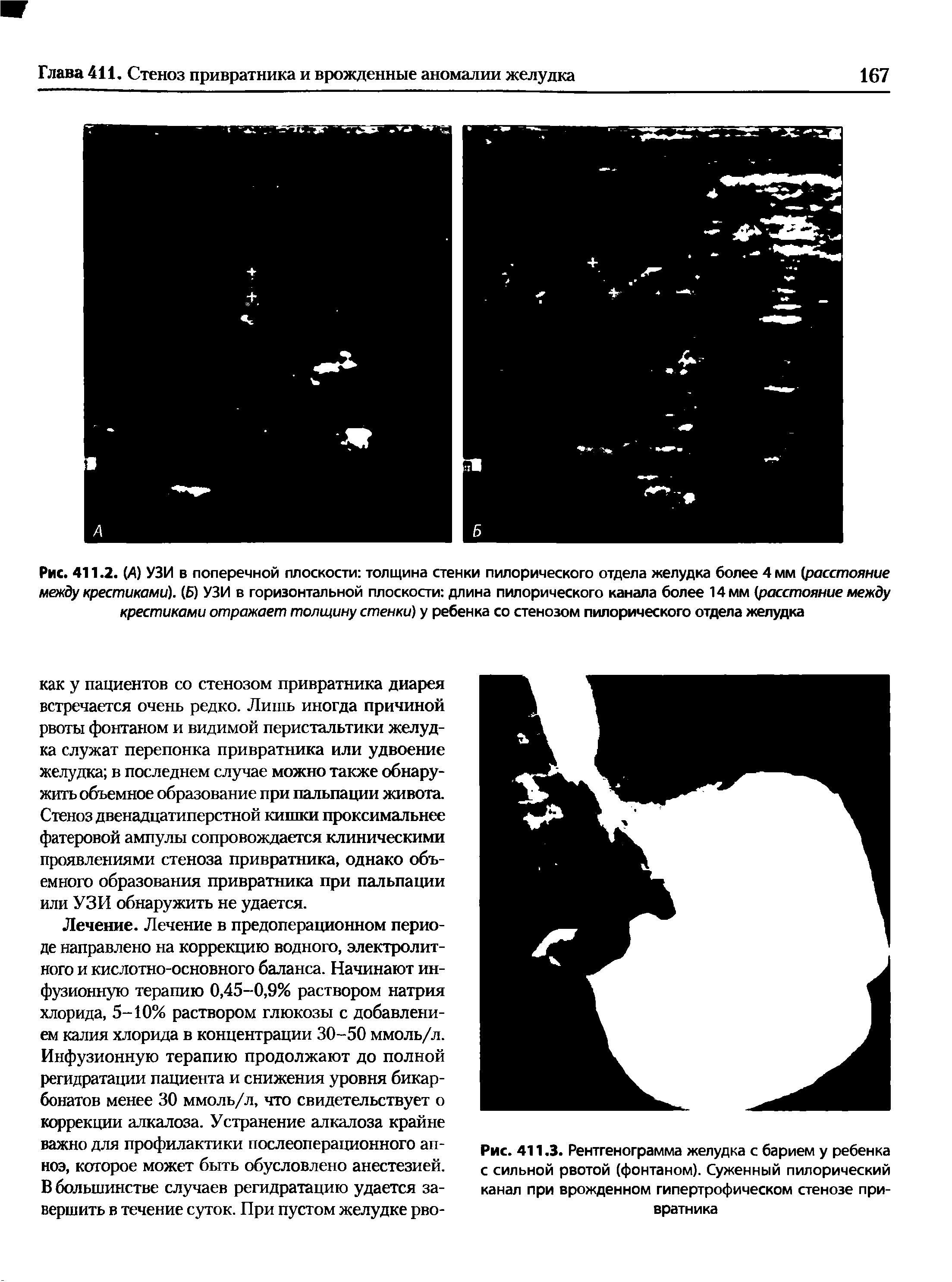 Рис. 411.2. (А) УЗИ в поперечной плоскости толщина стенки пилорического отдела желудка более 4 мм (расстояние между крестиками). (Б) УЗИ в горизонтальной плоскости длина пилорического канала более 14 мм (расстояние между крестиками отражает толщину стенки) у ребенка со стенозом пилорического отдела желудка...