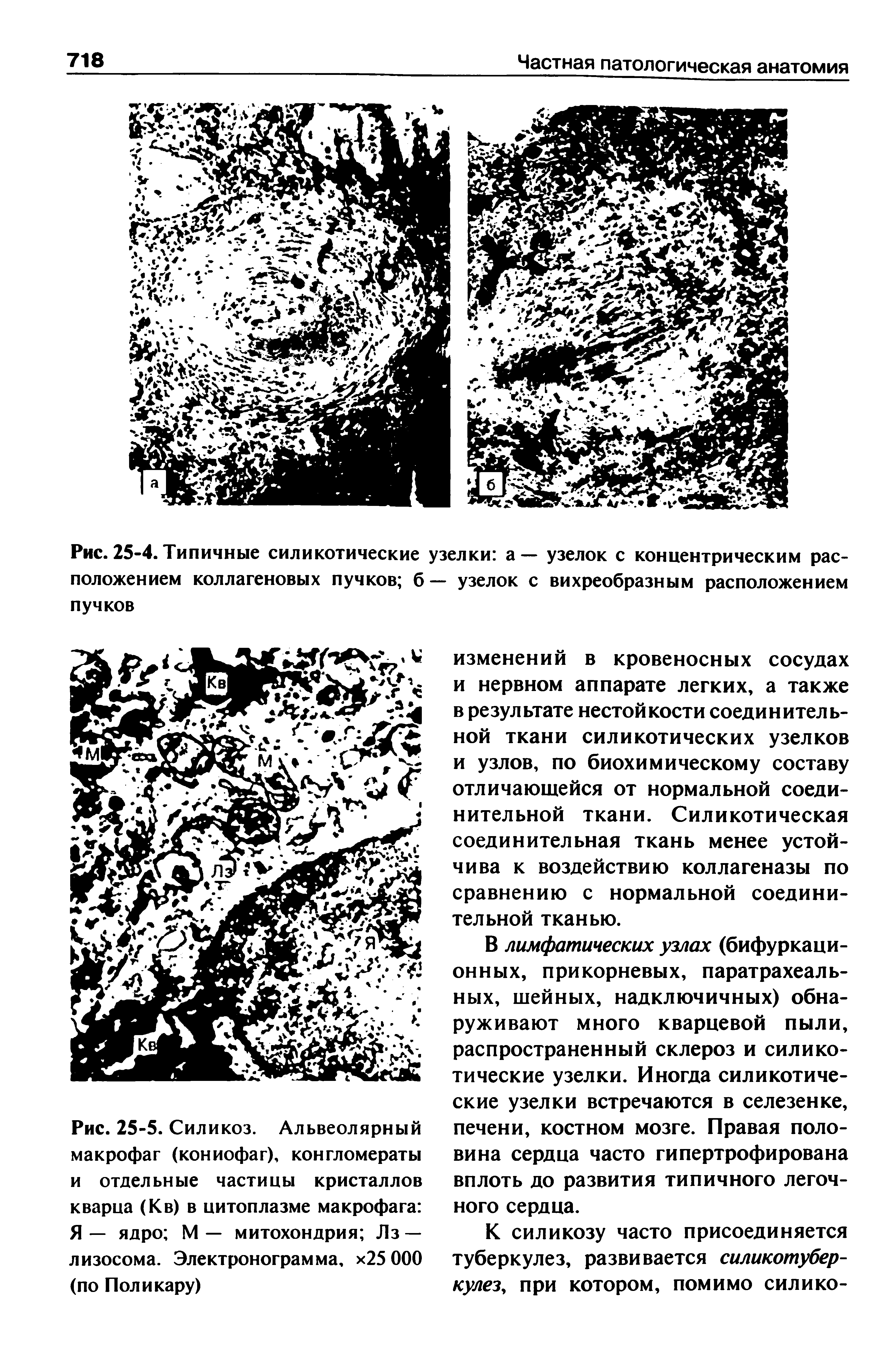 Рис. 25-5. Силикоз. Альвеолярный макрофаг (кониофаг), конгломераты и отдельные частицы кристаллов кварца (Кв) в цитоплазме макрофага Я — ядро М — митохондрия Лз — лизосома. Электронограмма, х25 000 (по Пол и кару)...