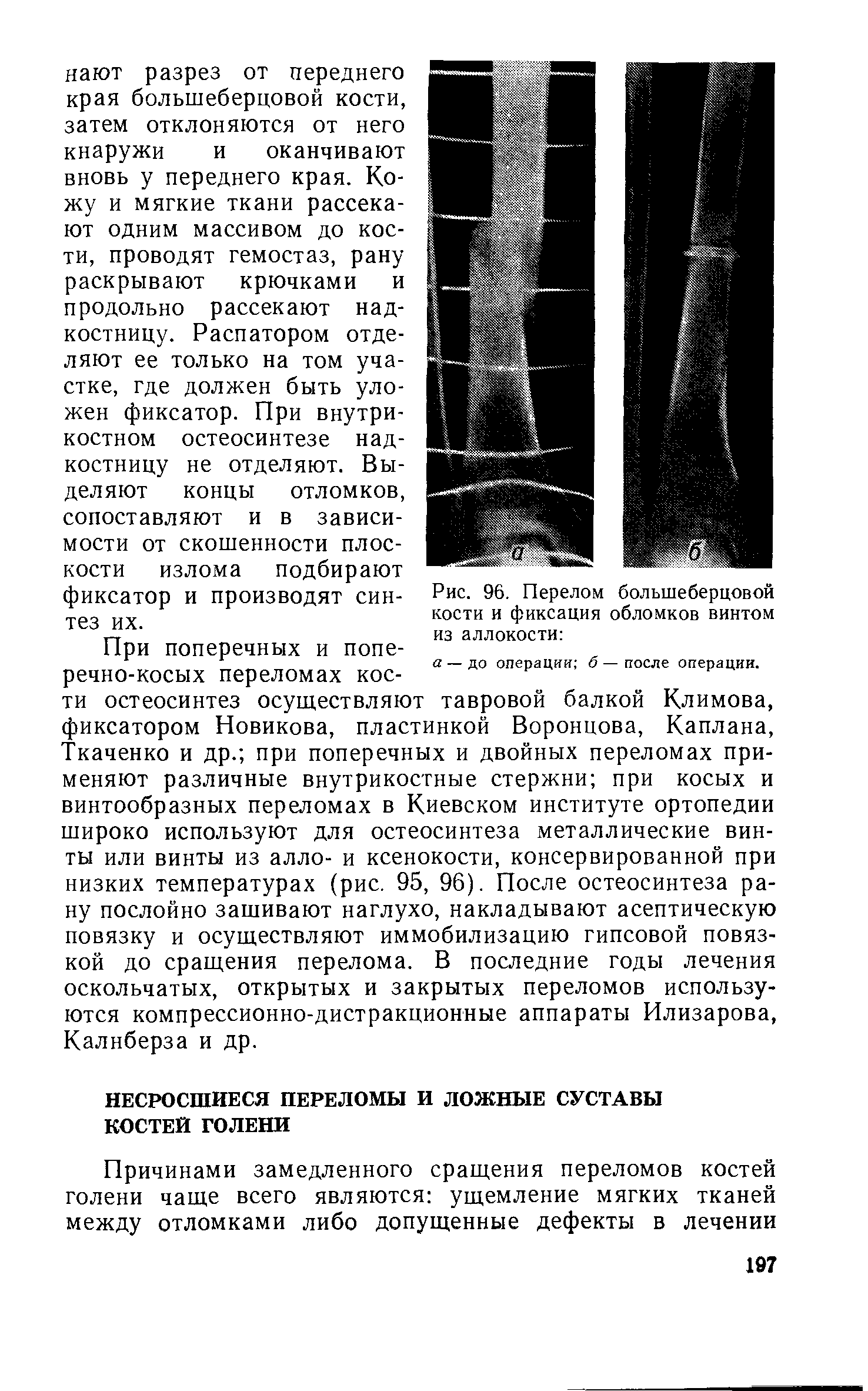 Рис. 96. Перелом большеберцовой кости и фиксация обломков винтом из аллокости ...