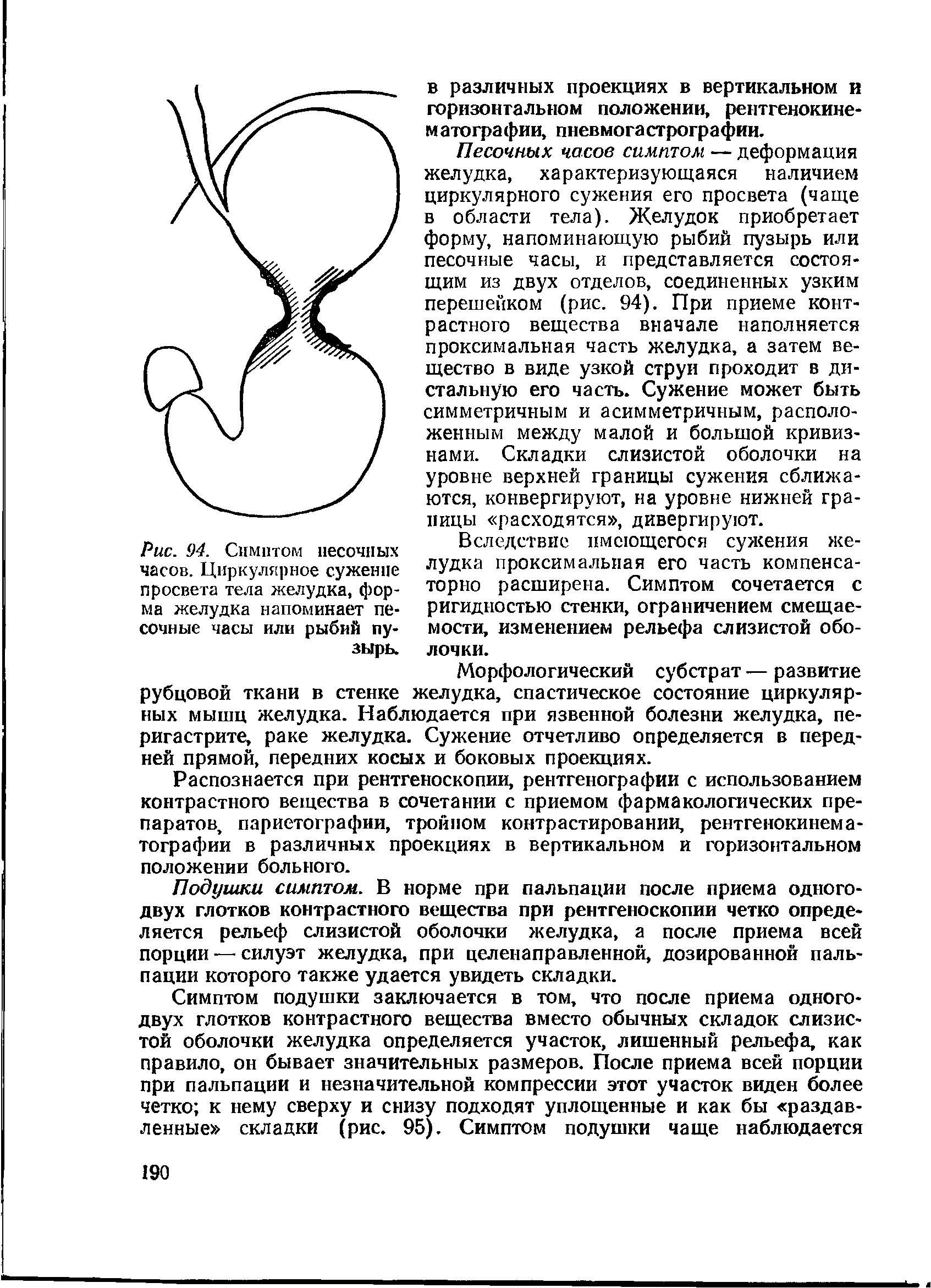 Рис. 94. Симптом песочных часов. Циркулярное сужение просвета тела желудка, форма желудка напоминает песочные часы или рыбий пузырь.