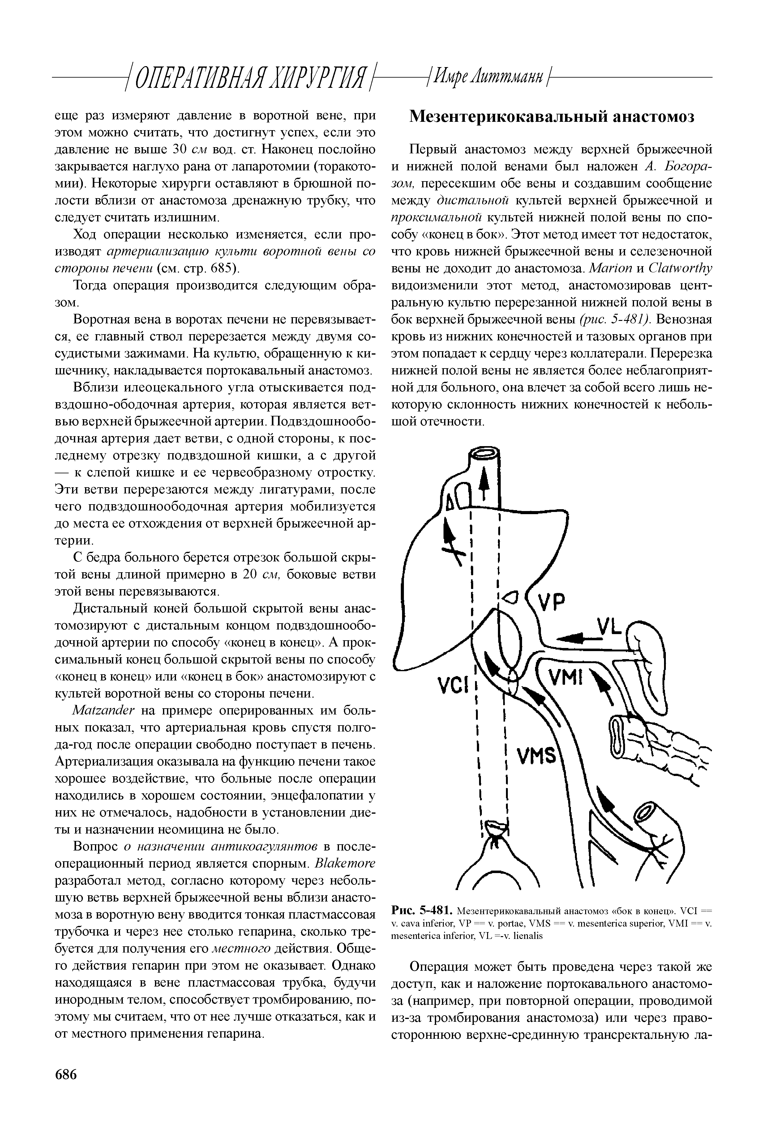 Рис. 5-481. Мезентерикокавальный анастомоз бок в конец . VCI == V. , VP == . , VMS == . , VMI == . , VL =- . ...