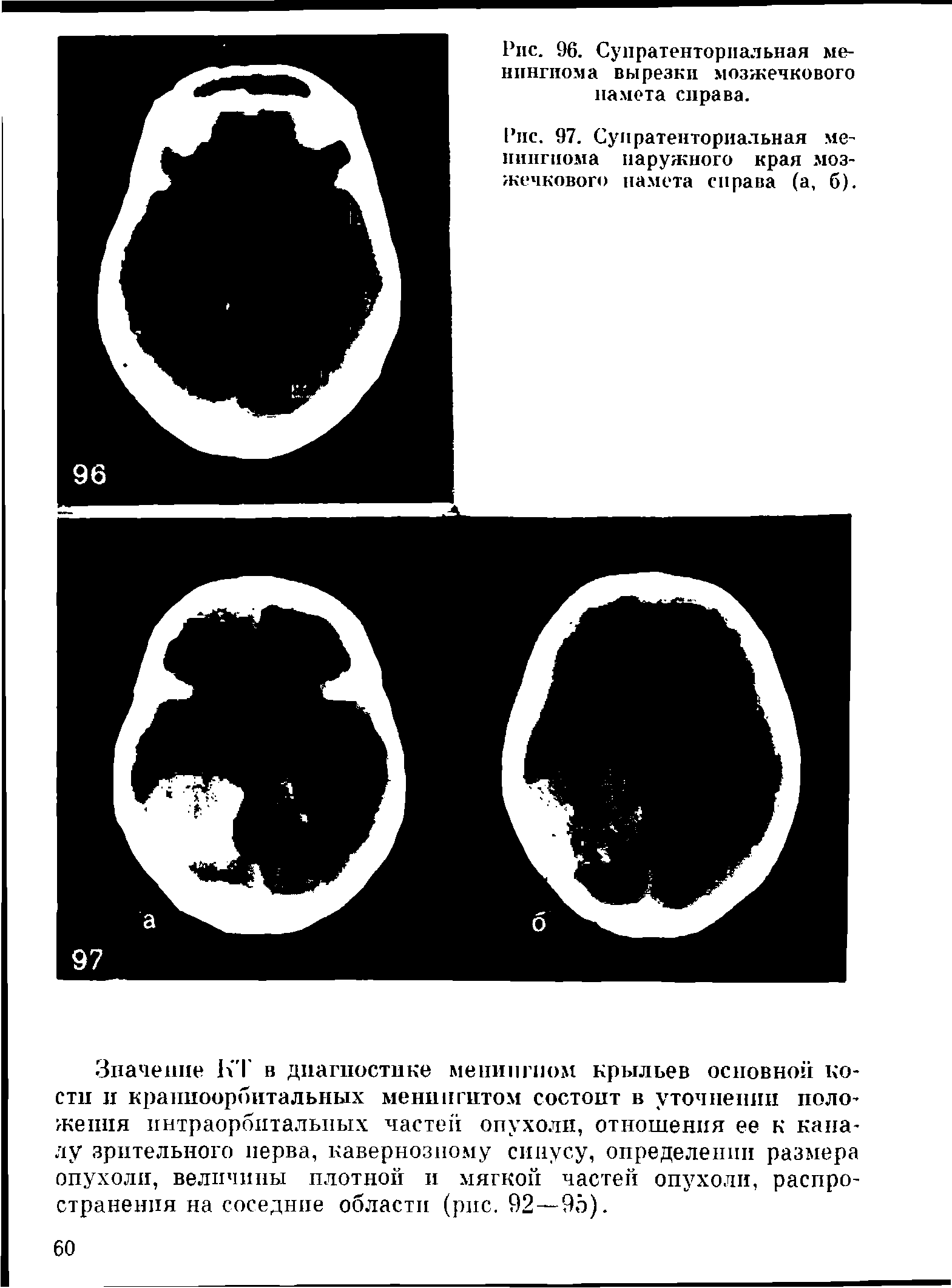 Рис. 97. Супратенториальная менингиома наружного края мозжечкового намета справа (а, б).