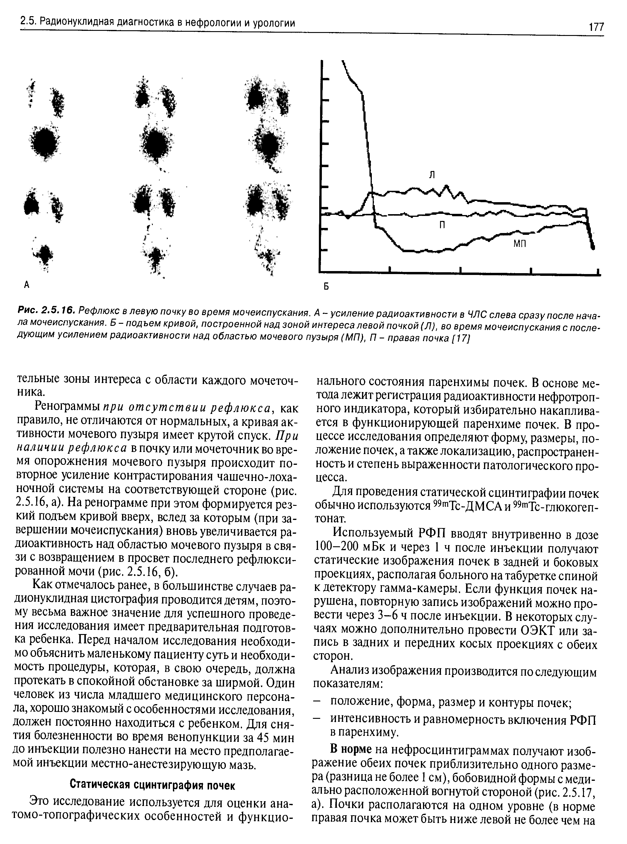 Рис. 2.5.16. Рефлюкс в левую почку во время мочеиспускания. А - усиление радиоактивности в ЧЛС слева сразу после начала мочеиспускания. Б - подъем кривой, построенной над зоной интереса левой почкой (Л), во время мочеиспускания с последующим усилением радиоактивности над областью мочевого пузыря (МП), П - правая почка [17]...