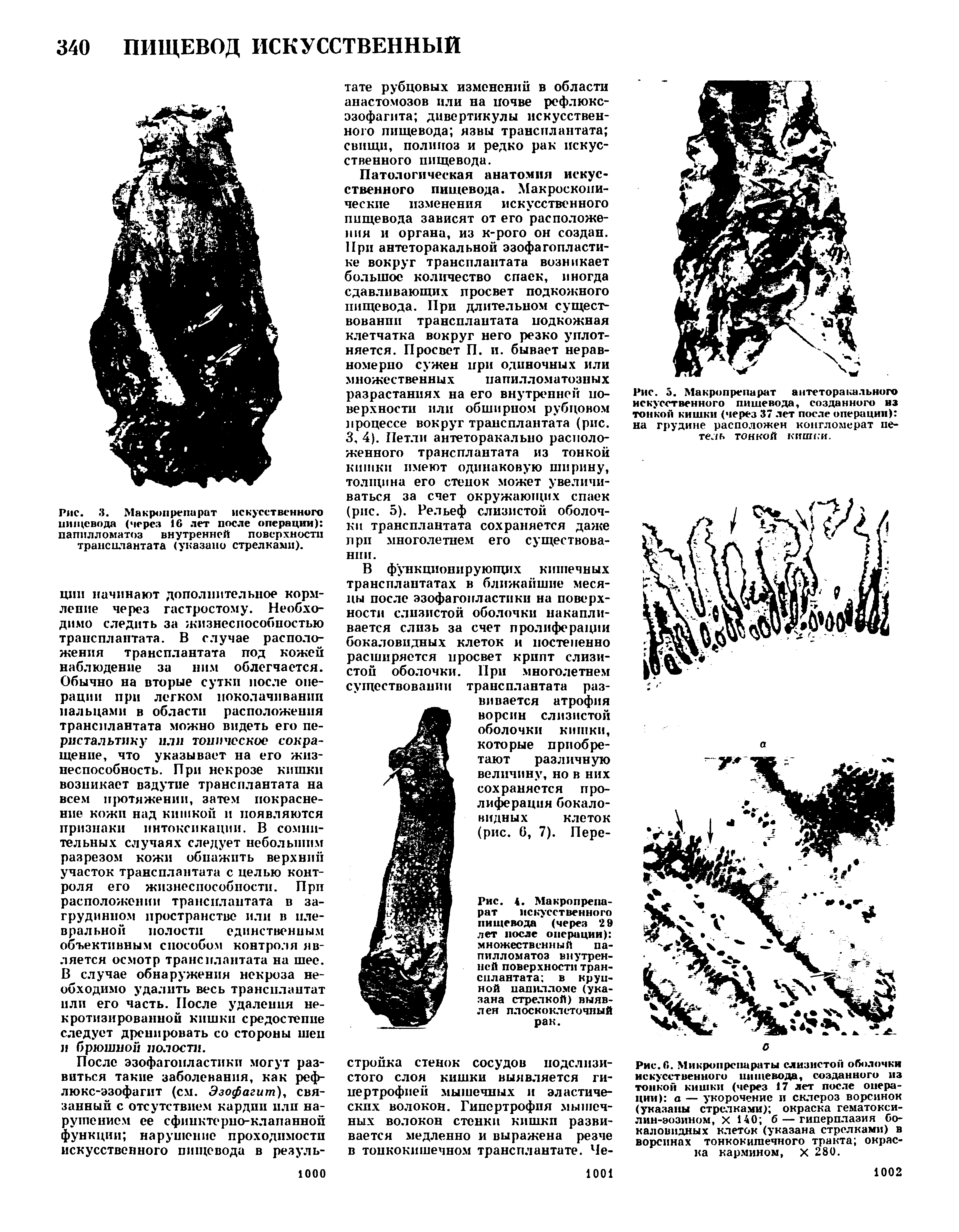 Рис. 5. Макропрепарат антеторакального искусственного пищевода, созданного из тонкой кишки (через 37 лет после операции) на грудине расположен конгломерат петель тонкой кишки.