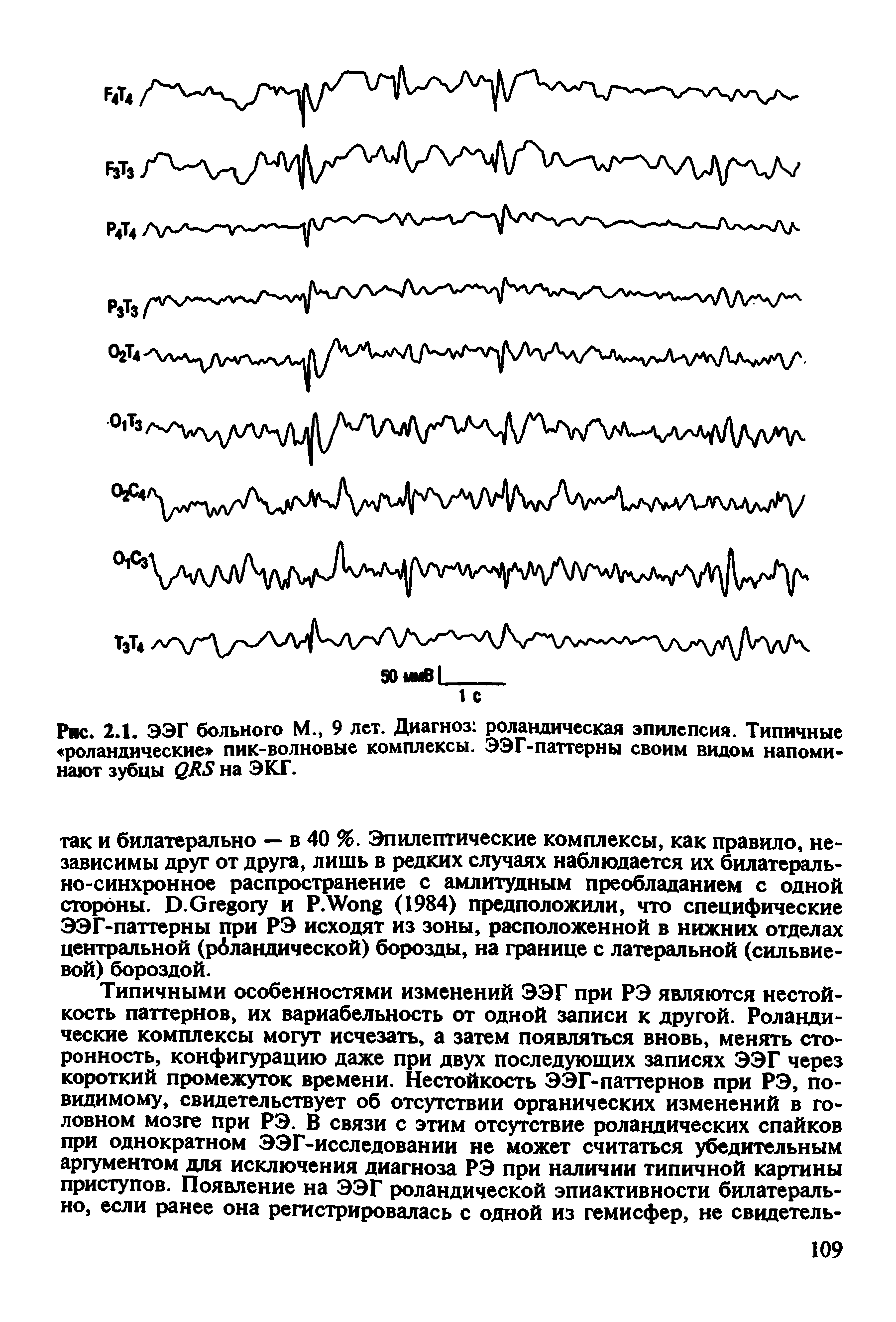 Рис. 2.1. ЭЭГ больного М., 9 лет. Диагноз роландическая эпилепсия. Типичные роландические пик-волновые комплексы. ЭЭГ-паттерны своим видом напоминают зубцы ЛУ на ЭКГ.