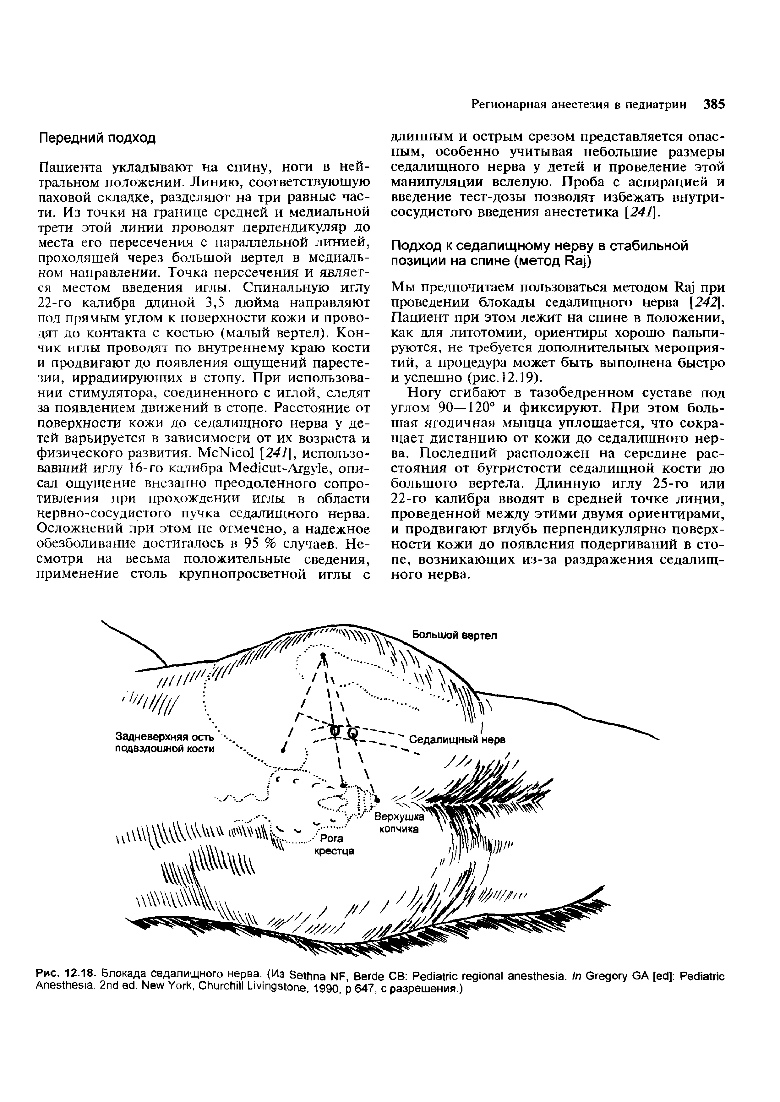 Рис. 12.18. Блокада седалищного нерва. (Из S NF, B СВ P . I G GA [ ] P ...