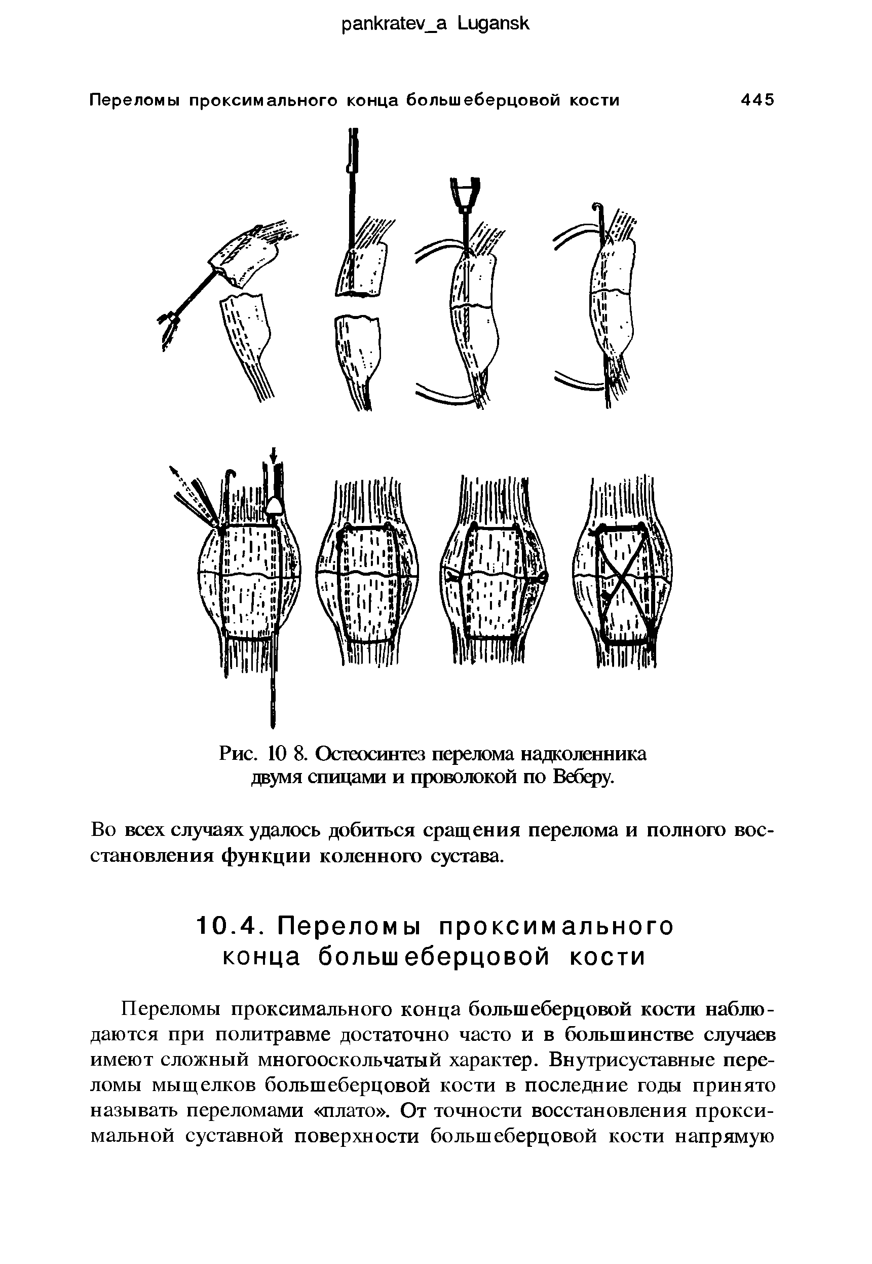 Рис. 10 8. Остеосинтез перелома надколенника двумя спицами и проволокой по Веберу.