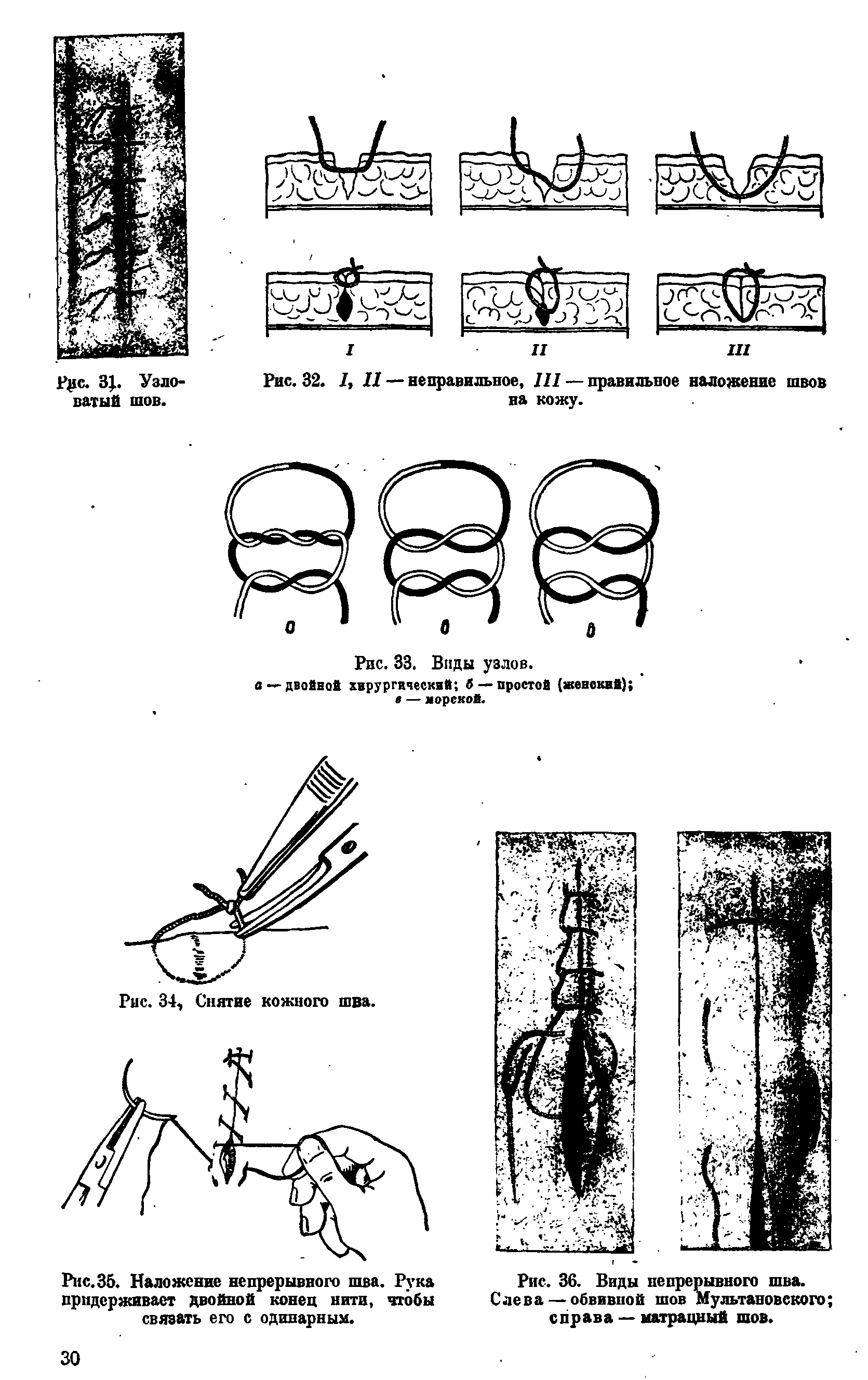 Шов мультановского схема