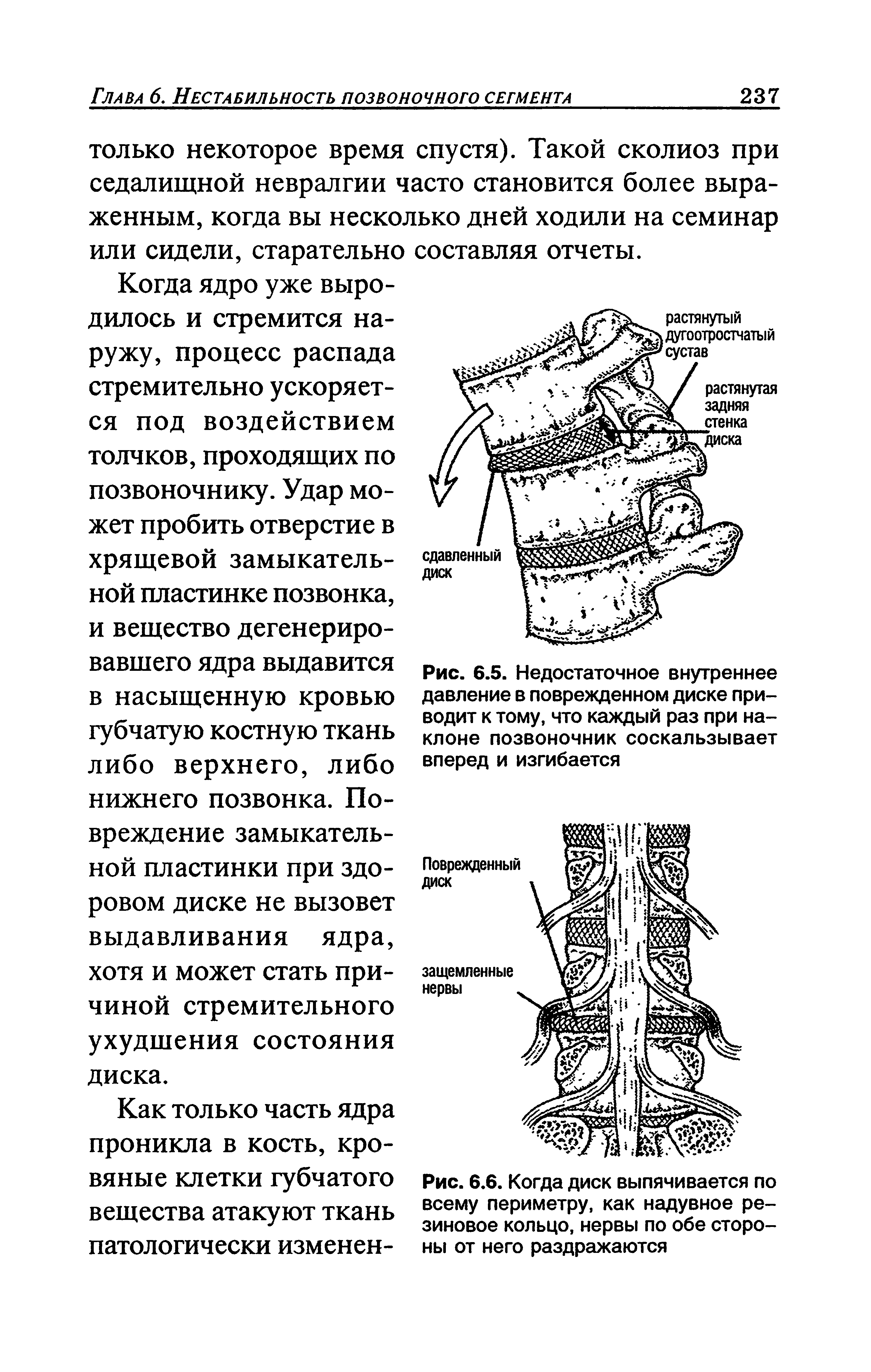 Рис. 6.6. Когда диск выпячивается по всему периметру, как надувное резиновое кольцо, нервы по обе стороны от него раздражаются...