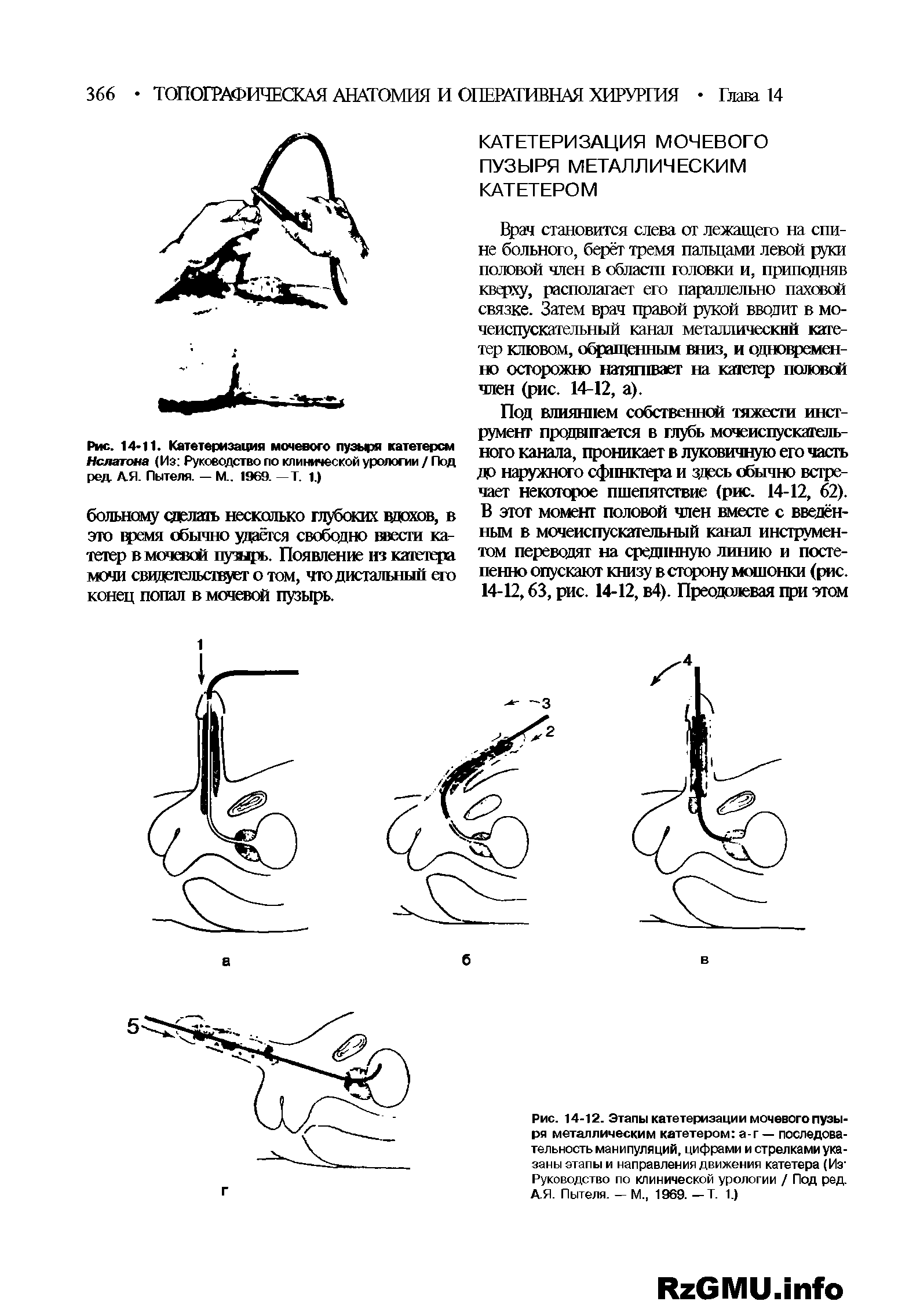 Рис. 14-12. Этапы катетеризации мочевого пузыря металлическим катетером а-г — последовательность манипуляций, цифрами и стрелками указаны этапы и направления движения катетера (Из1 Руководство по клинической урологии / Под ред. А.Я. Пытеля. - М., 1969. -Т. 1.)...