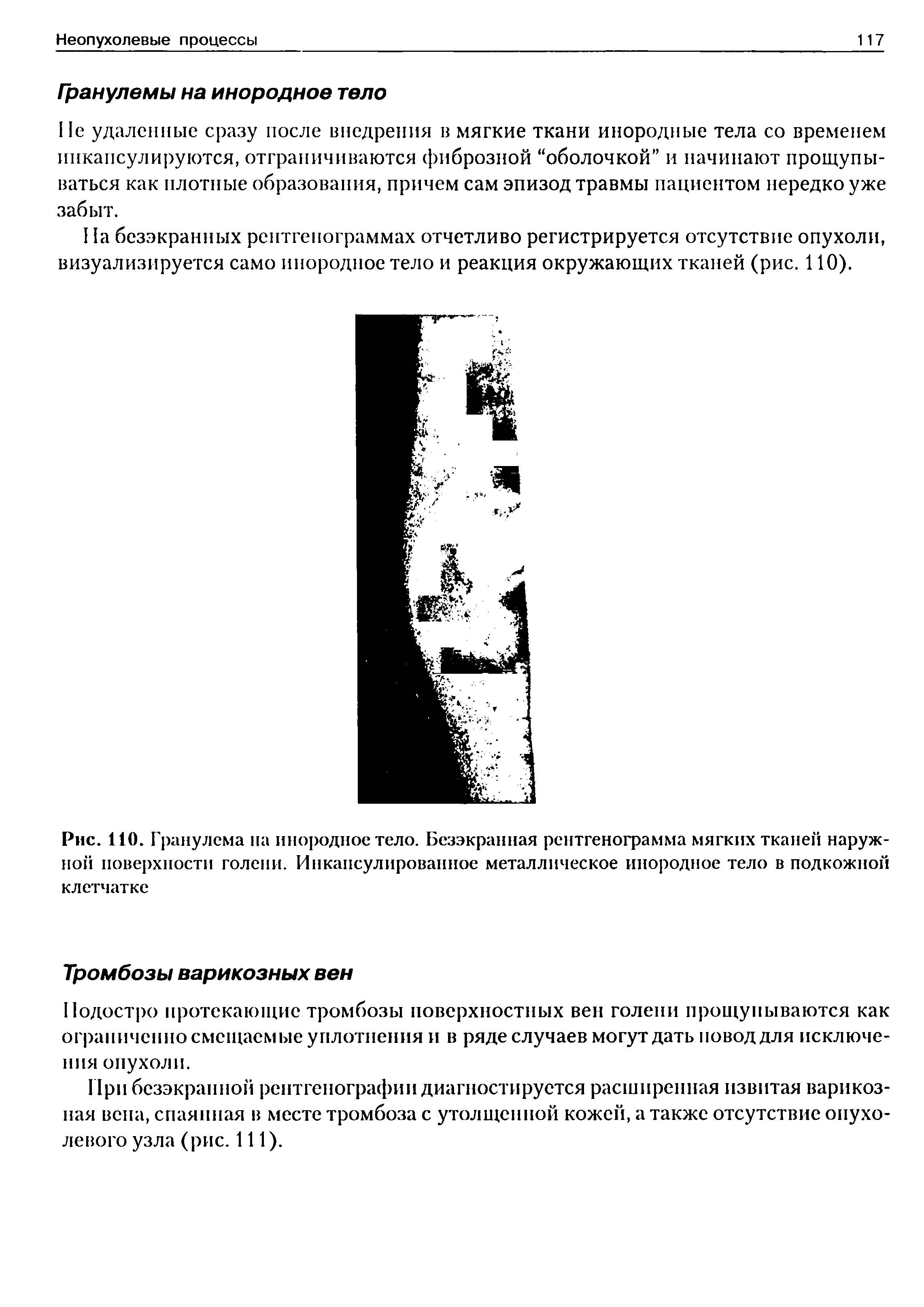 Рис. 110. Гранулема на инородное тело. Безэкранная рентгенограмма мягких тканей наружной поверхности голени. И и капсулированное металлическое инородное тело в подкожной клетчатке...