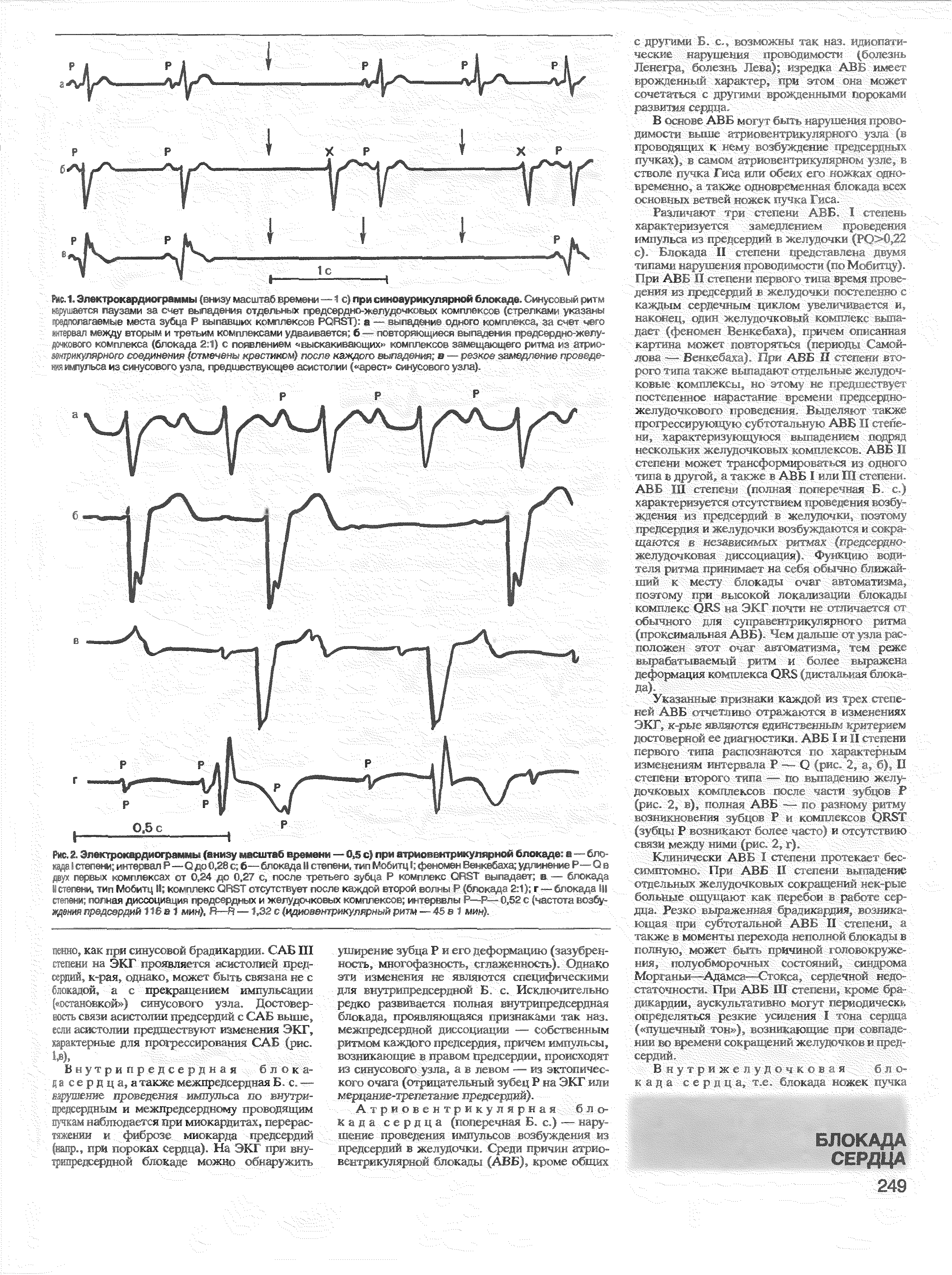 Рис. 2. Электрокардиограммы (внизу масштаб времени — 0,5 с) при атриовентрикулярной блокаде в — блокада I степени интервал Р —-О до 0,28 с б—блокада II степени, тип Мобитц I феномен Венкебаха удлинение Р—О в двух первых комплексах от 0,24 до 0,27 с, после третьего зубца Р комплекс ОТЭТ выпадает в — блокада Истепени, тип Мобитц II комплекс ОГКТотсутствует после каждой второй вс юкада 2 1) г—-блокада III...