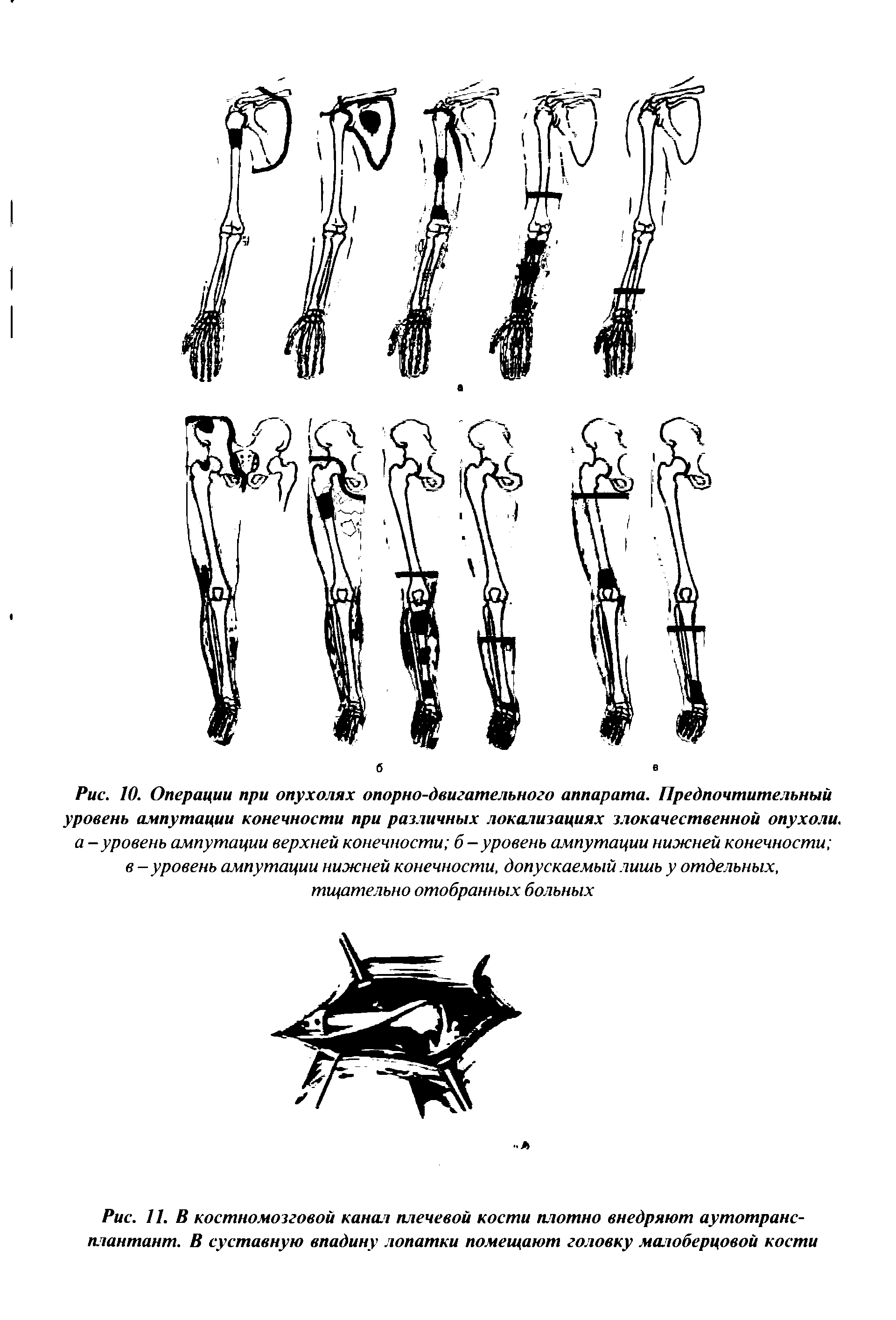 Рис. 11. В костномозговой канал плечевой кости плотно внедряют аутотрансплантант. В суставную впадину лопатки помещают головку малоберцовой кости...
