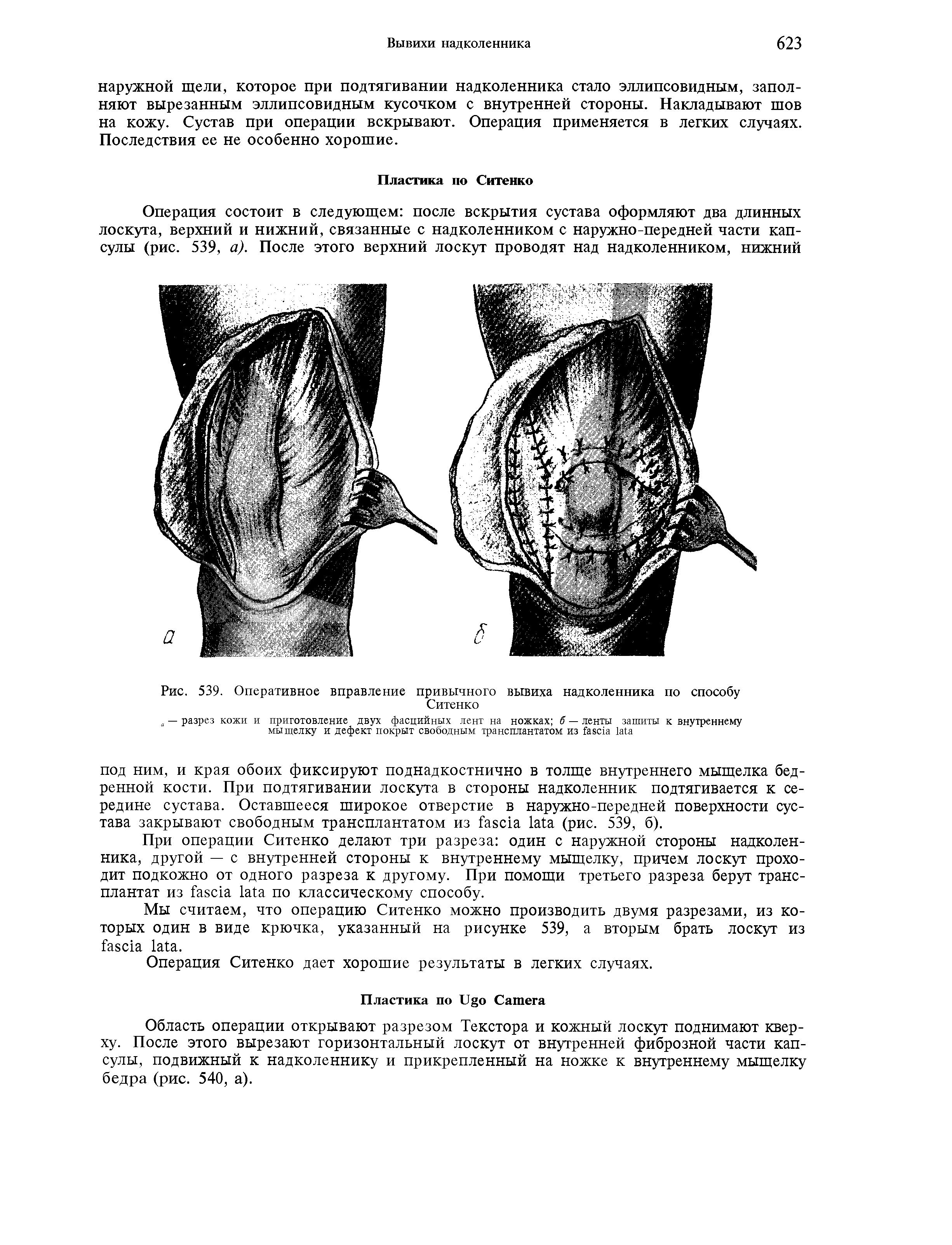 Рис. 539. Оперативное вправление привычного вывиха надколенника по способу Ситенко...