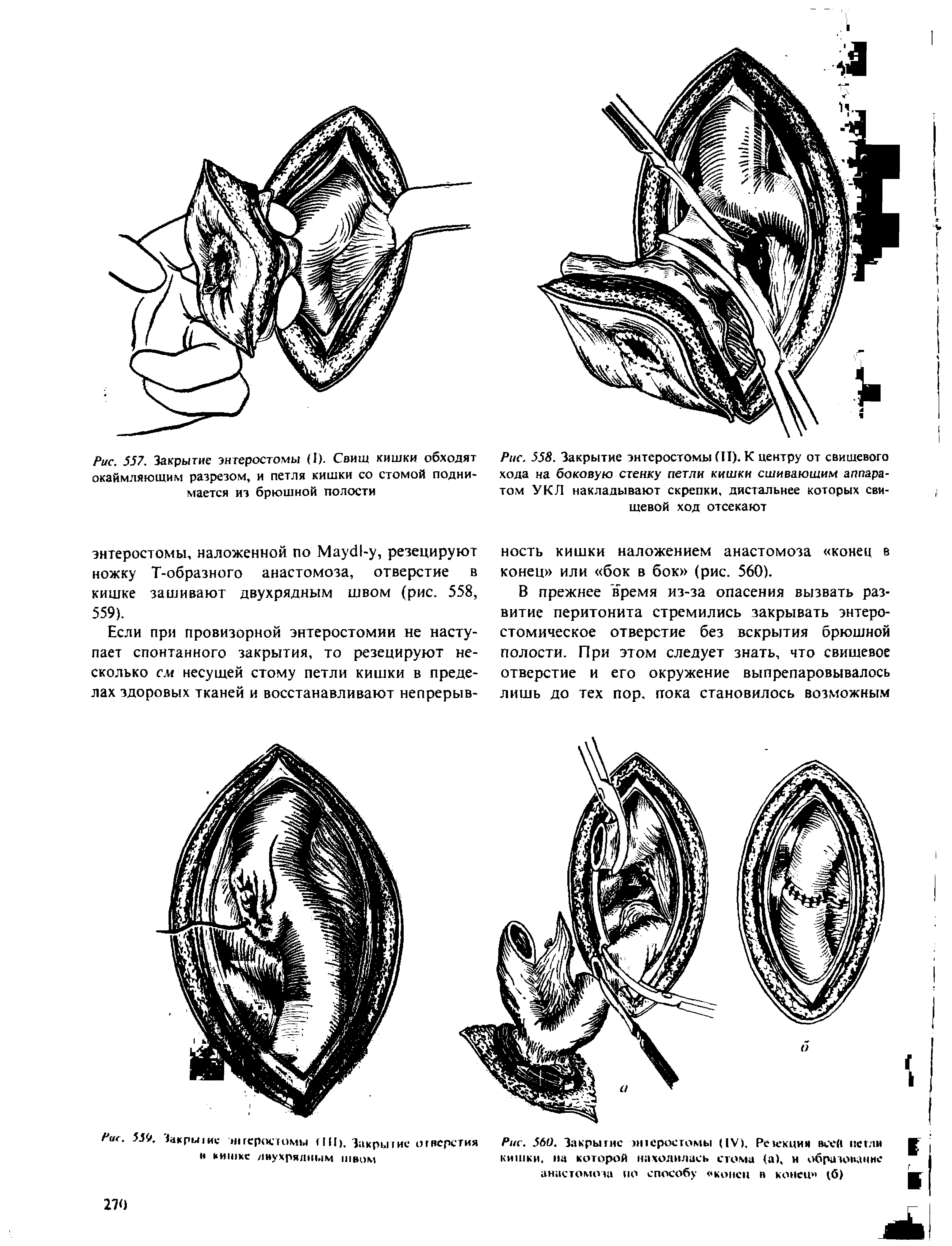 Рис. 558. Закрытие энтеростомы (П). К центру от свищевого хода на боковую стенку петли кишки сшивающим аппаратом УКЛ накладывают скрепки, дистальнее которых свищевой ход отсекают...