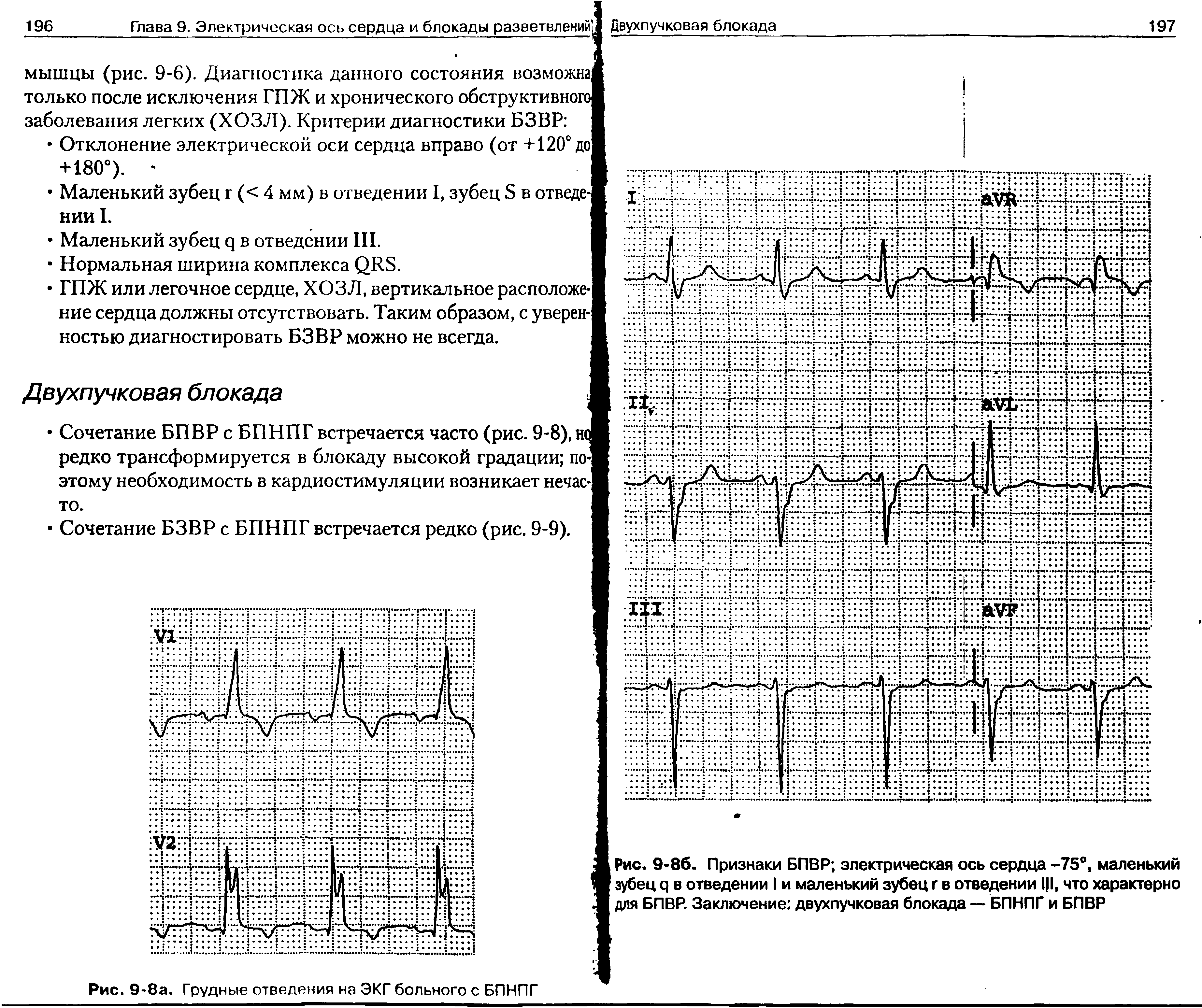 Рис. 9-86. Признаки БПВР электрическая ось сердца -75°, маленький зубец ч в отведении I и маленький зубец г в отведении 1 1, что характерно для БПВР. Заключение двухпучковая блокада — БПНПГ и БПВР...